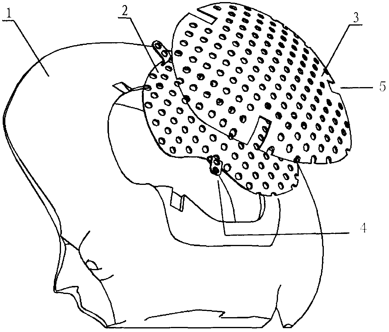 Double-layer titanium mesh for cranioplasty