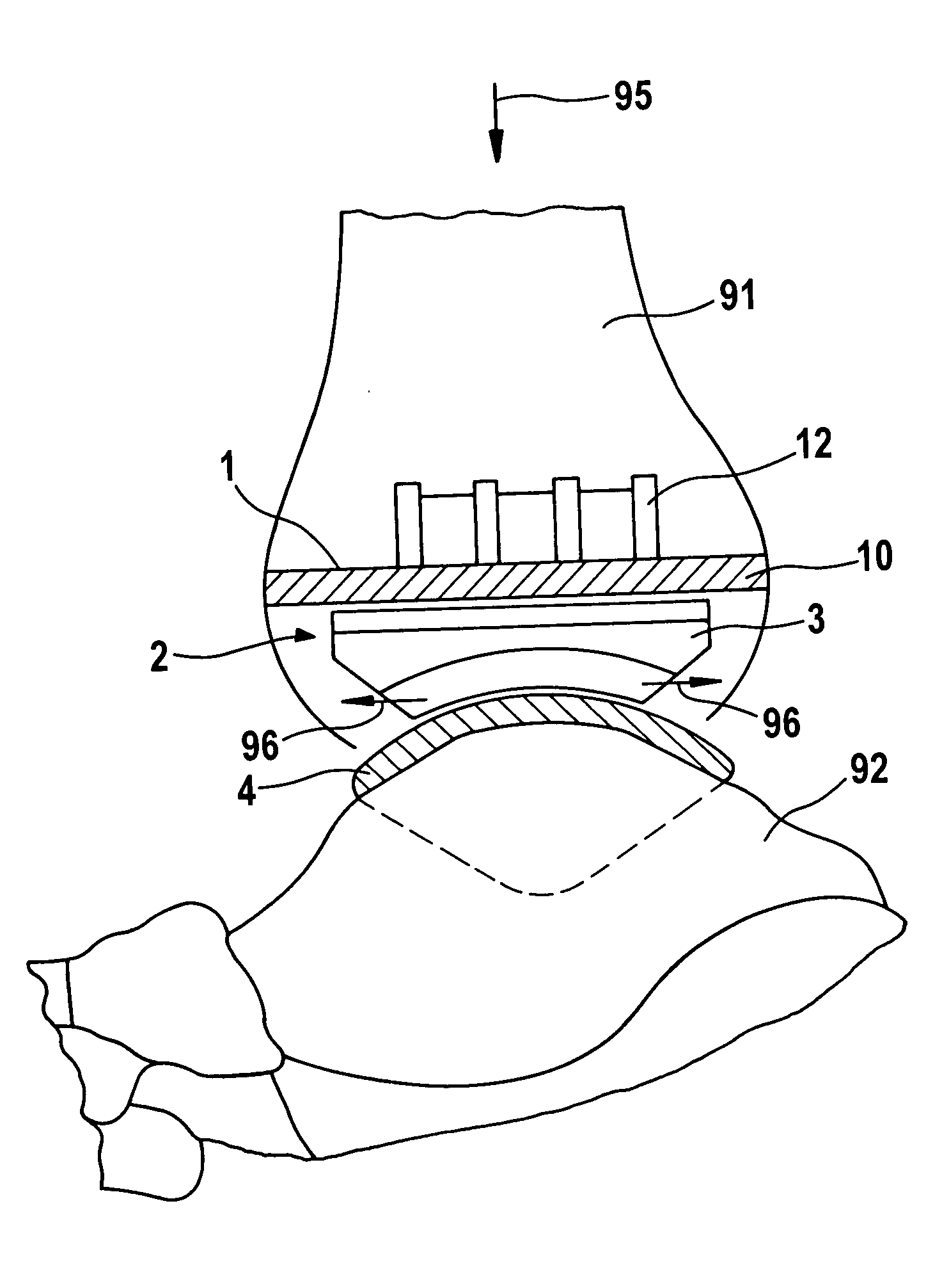 Endoprosthesis with intermediate part