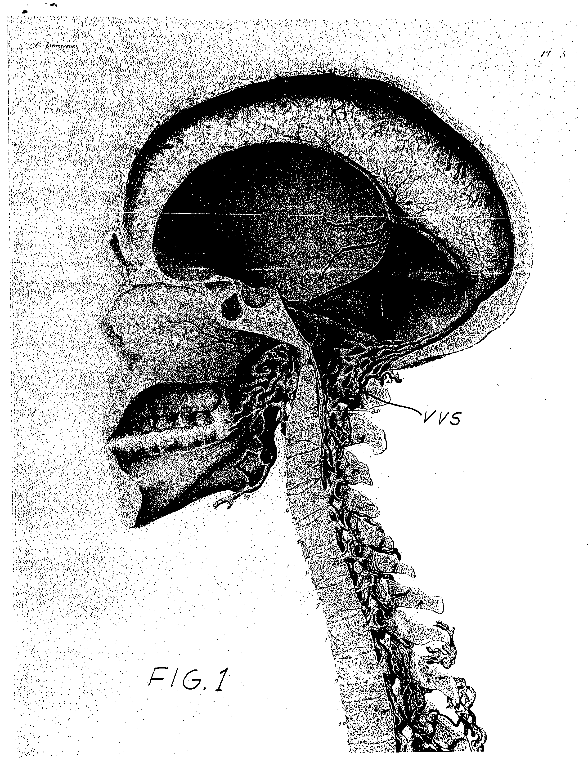 Use and methods of use of etanercept and other TNF binding biologics to improve human cognitive function