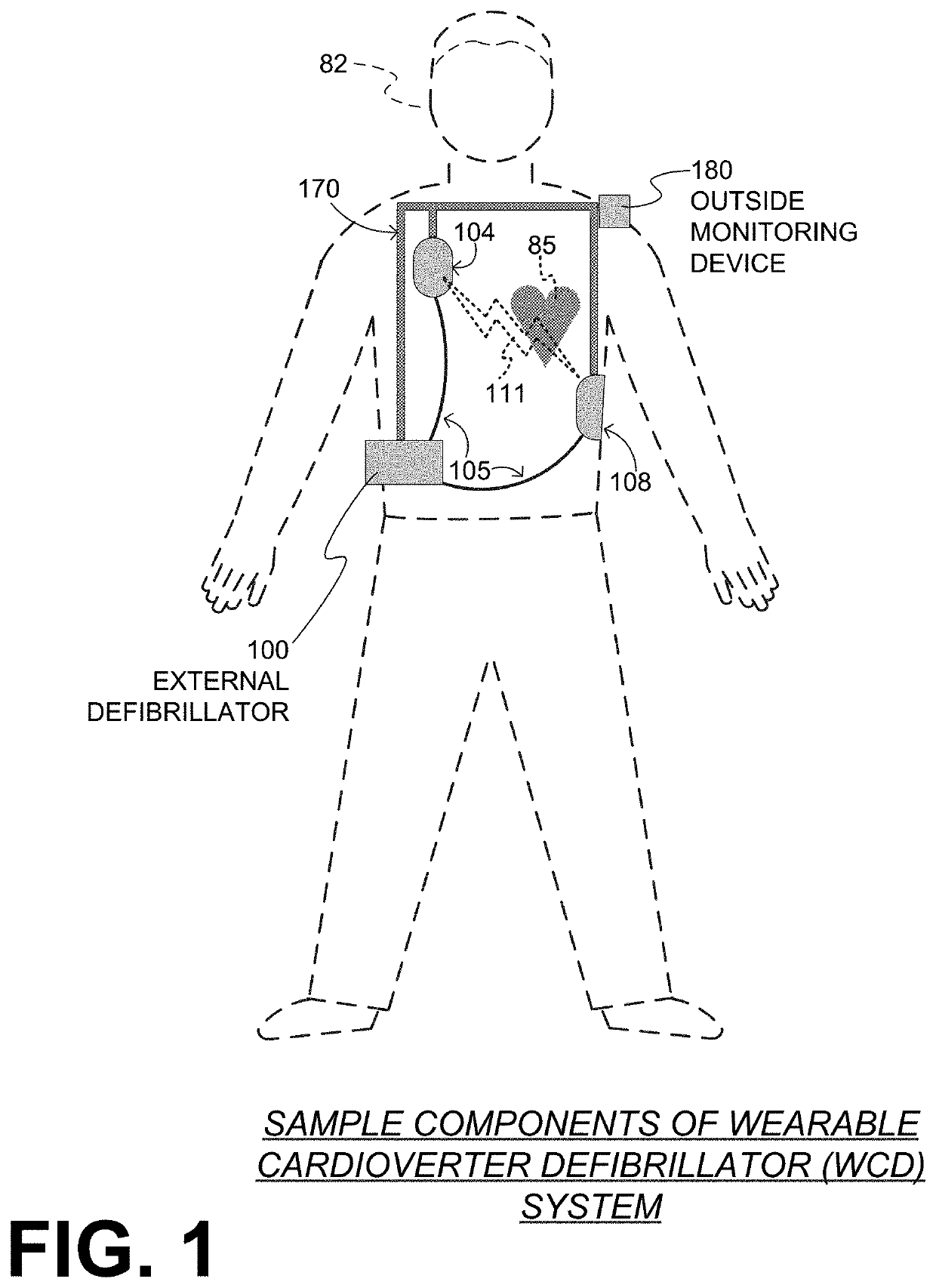 Wearable cardioverter defibrillator (WCD) system reacting to high-amplitude ECG noise