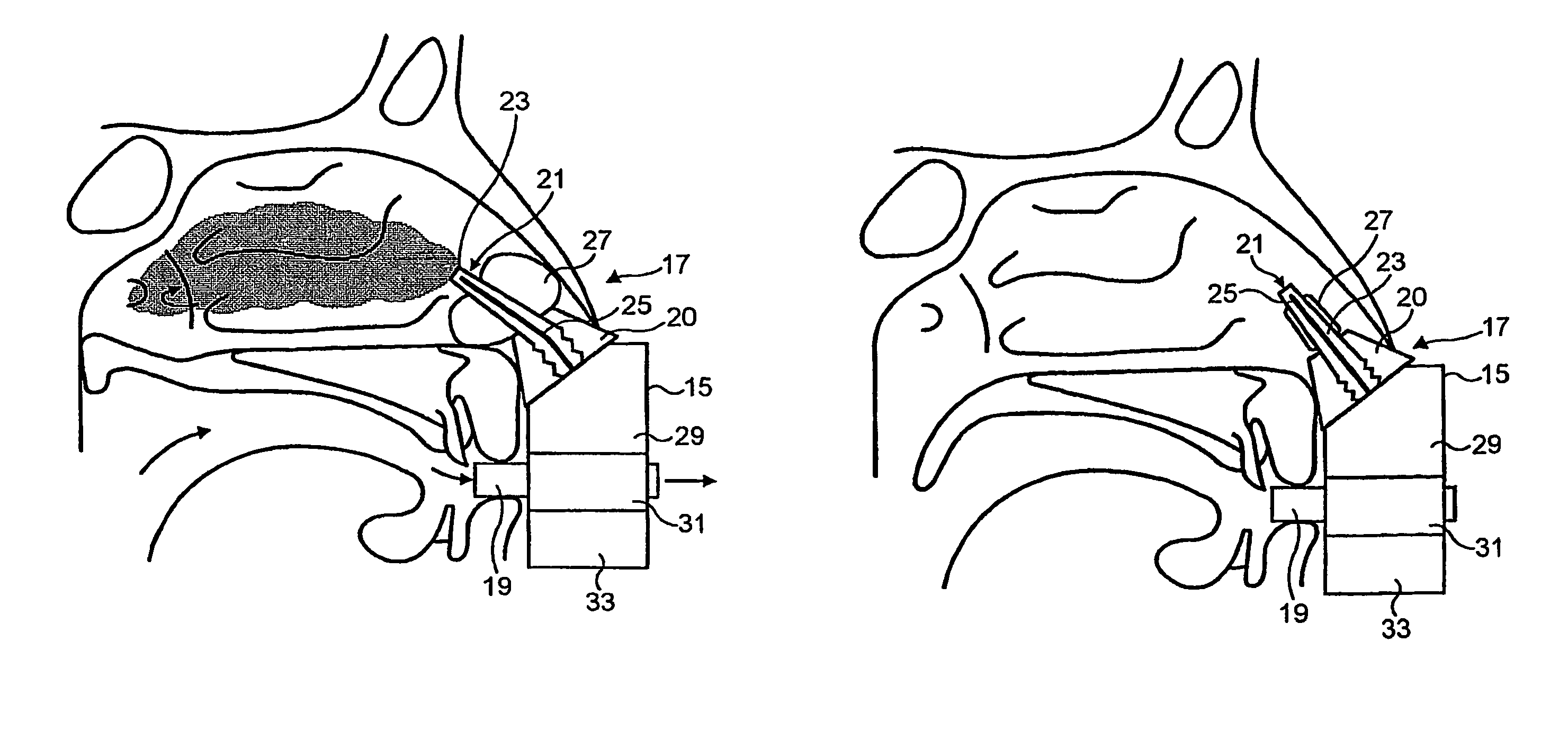 Nasal devices