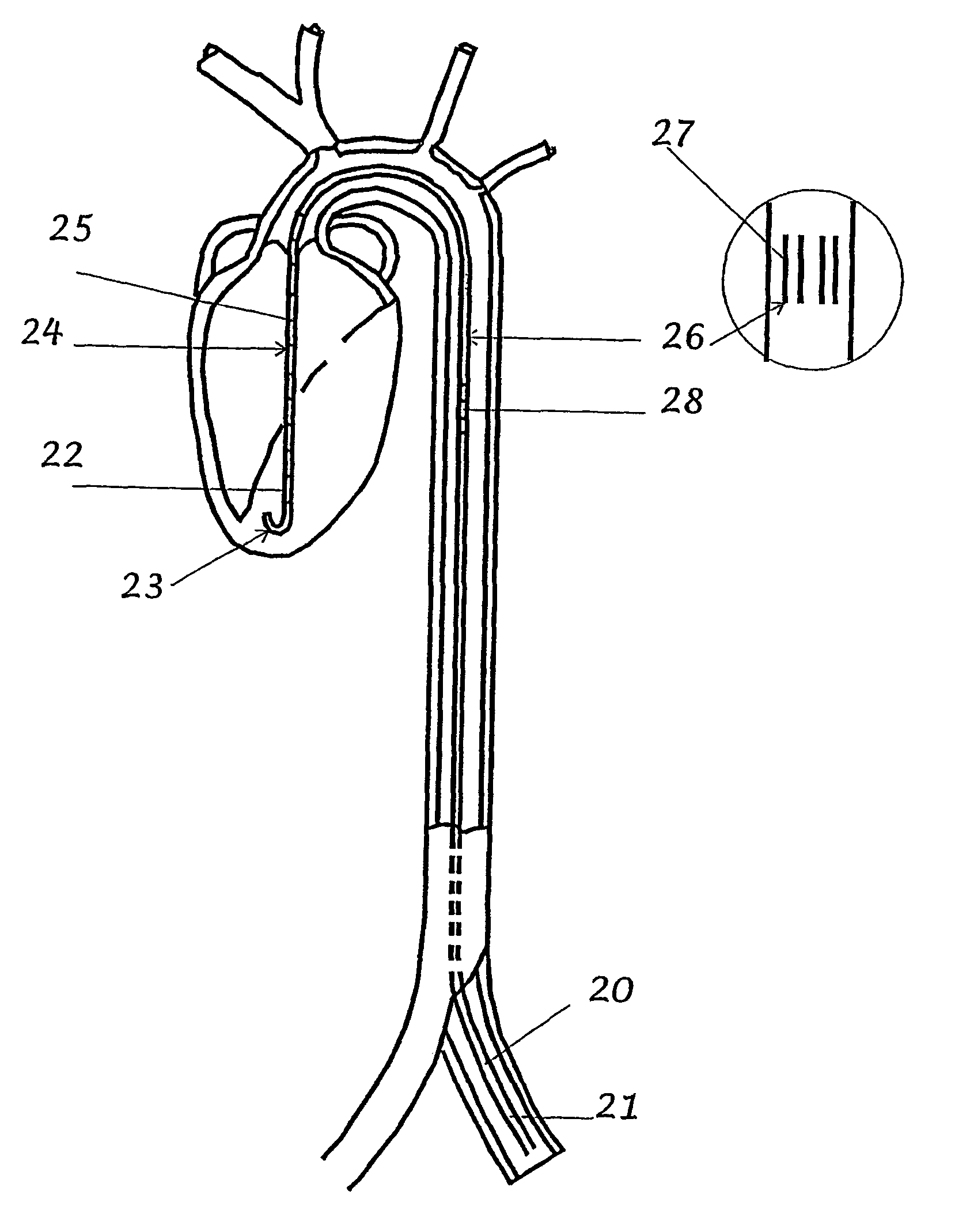 Method and device for determining the segmental volume and electrical parallel conductance of a cardiac chamber or blood vessel