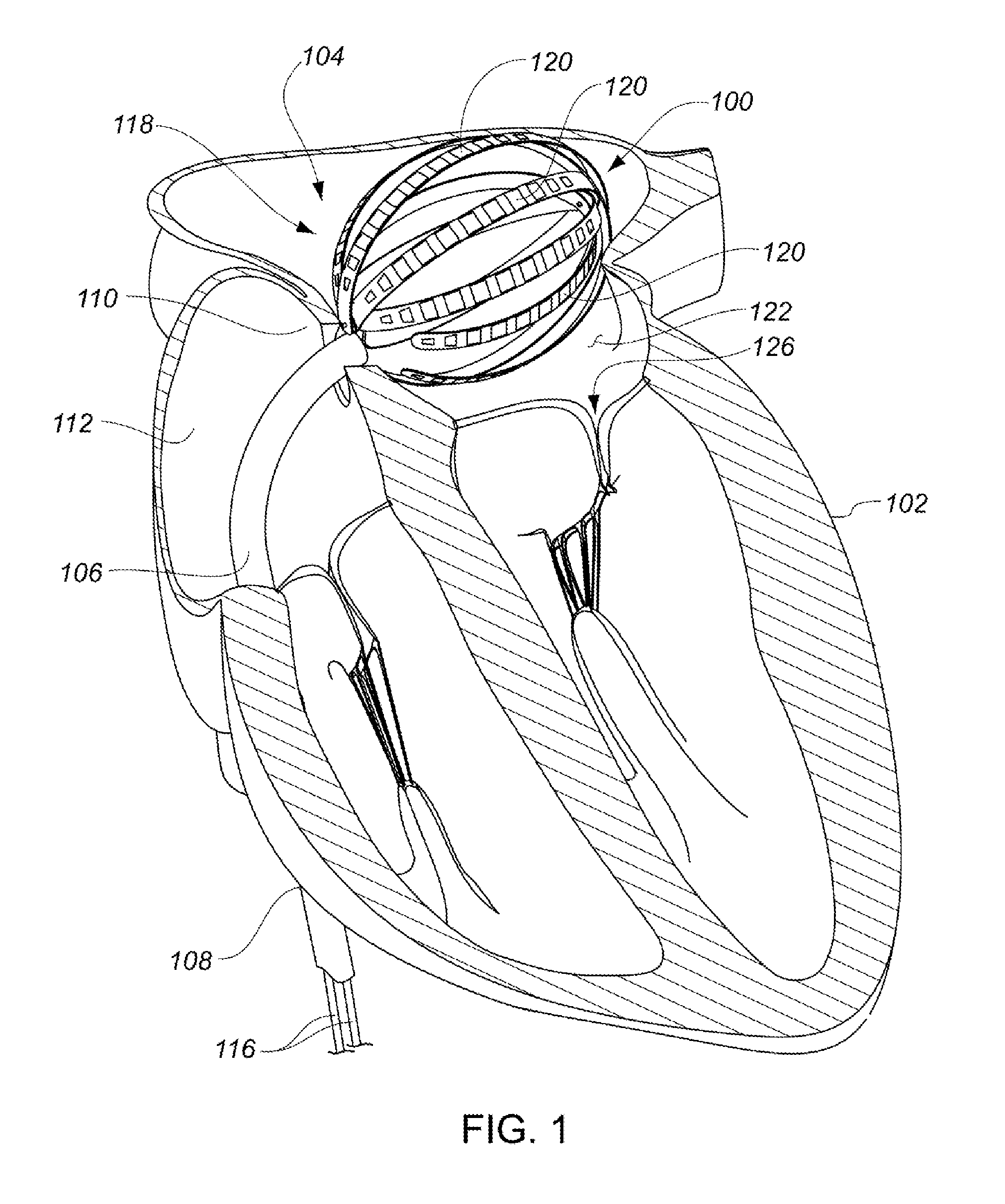 Enhanced medical device for use in bodily cavities, for example an atrium