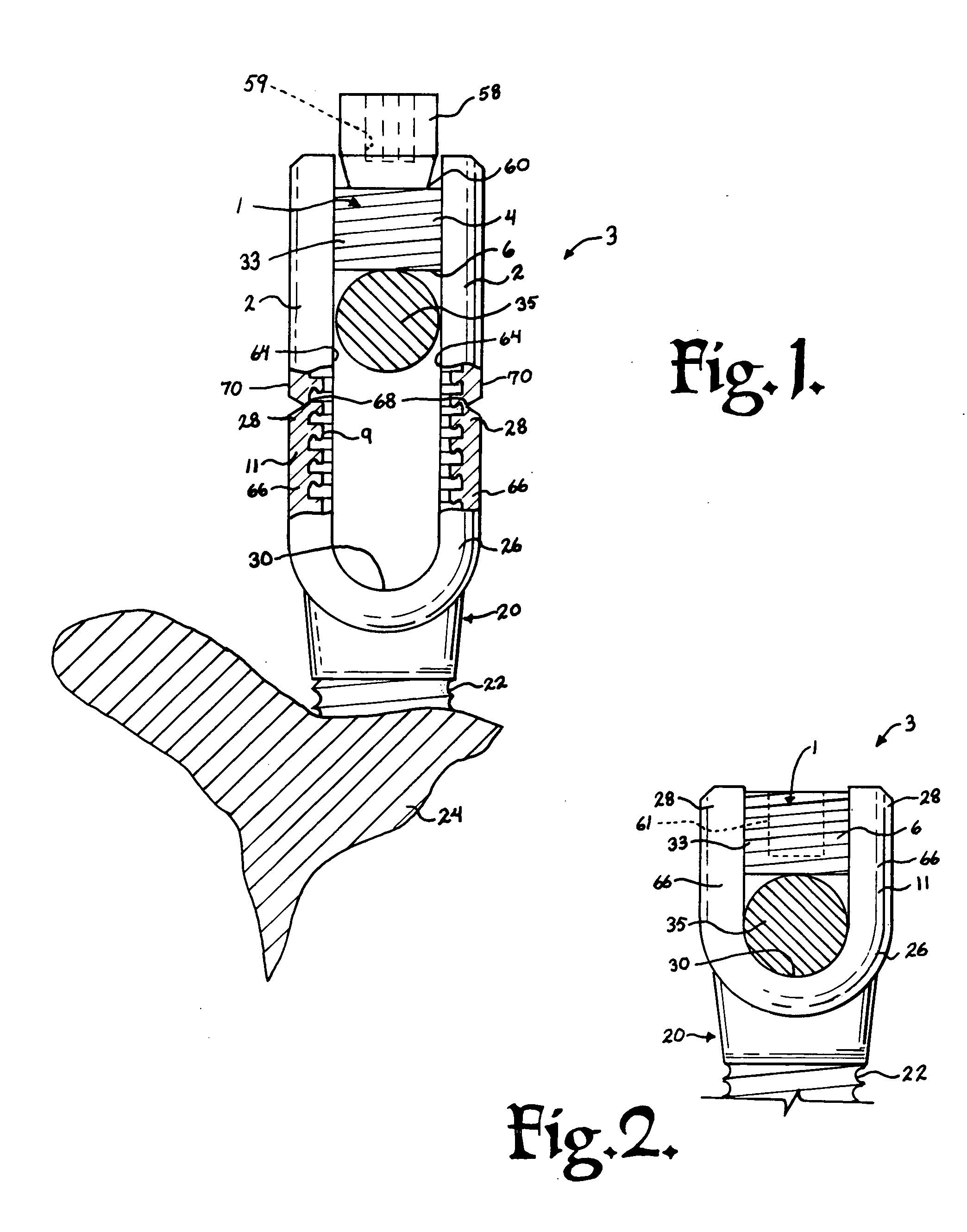 Helical guide and advancement flange with radially loaded lip