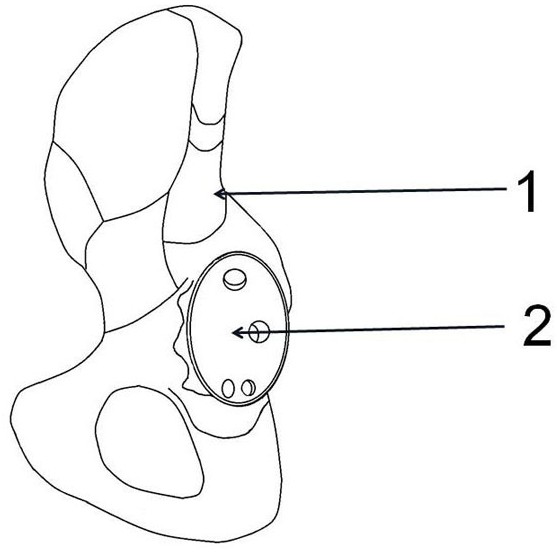 3D printing expansion press-fit type acetabular revision prosthesis