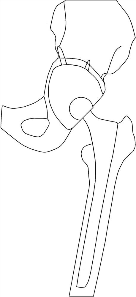 3D printing expansion press-fit type acetabular revision prosthesis