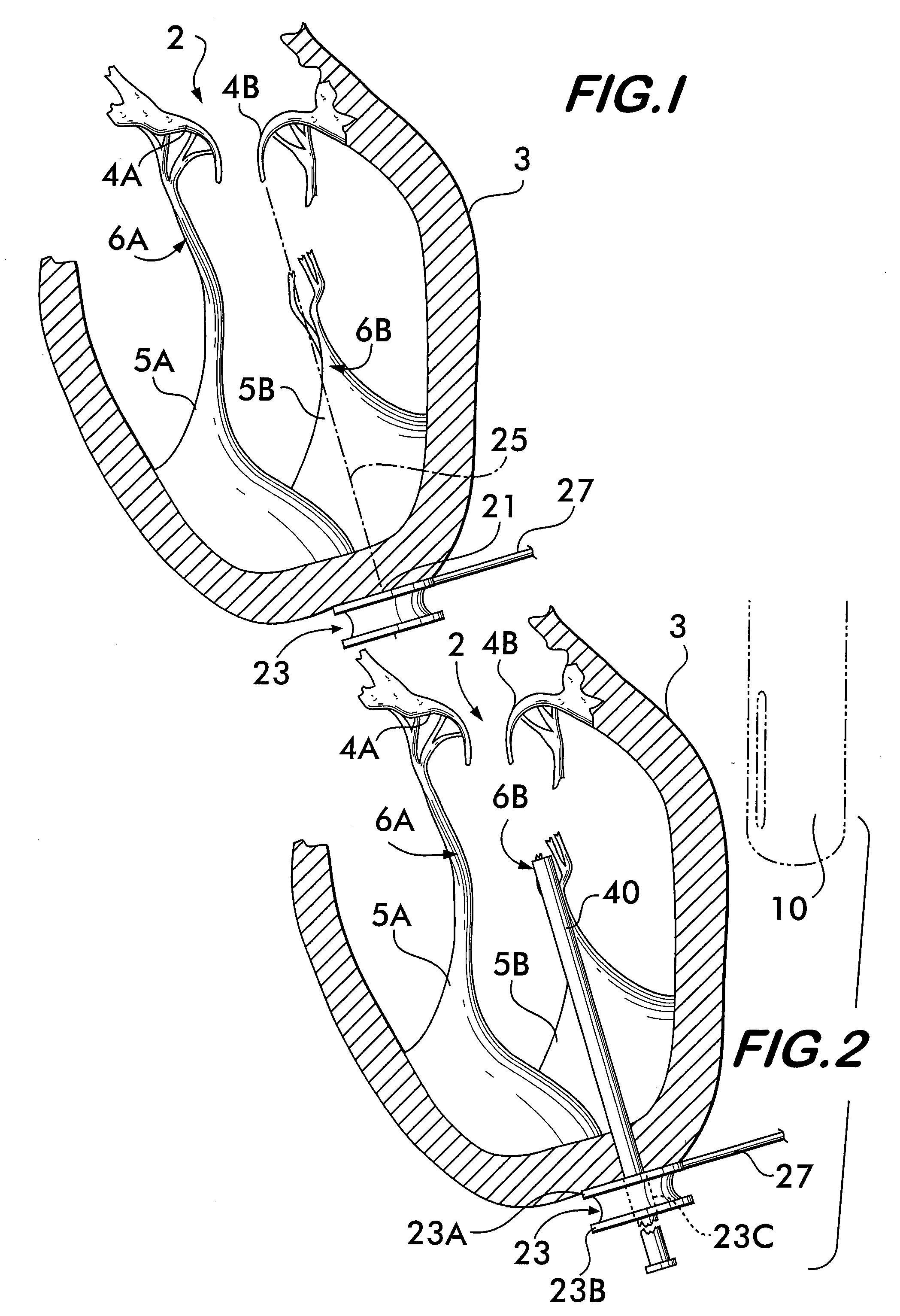 Apparatus and method for mitral valve repair without cardiopulmonary bypass, including transmural techniques