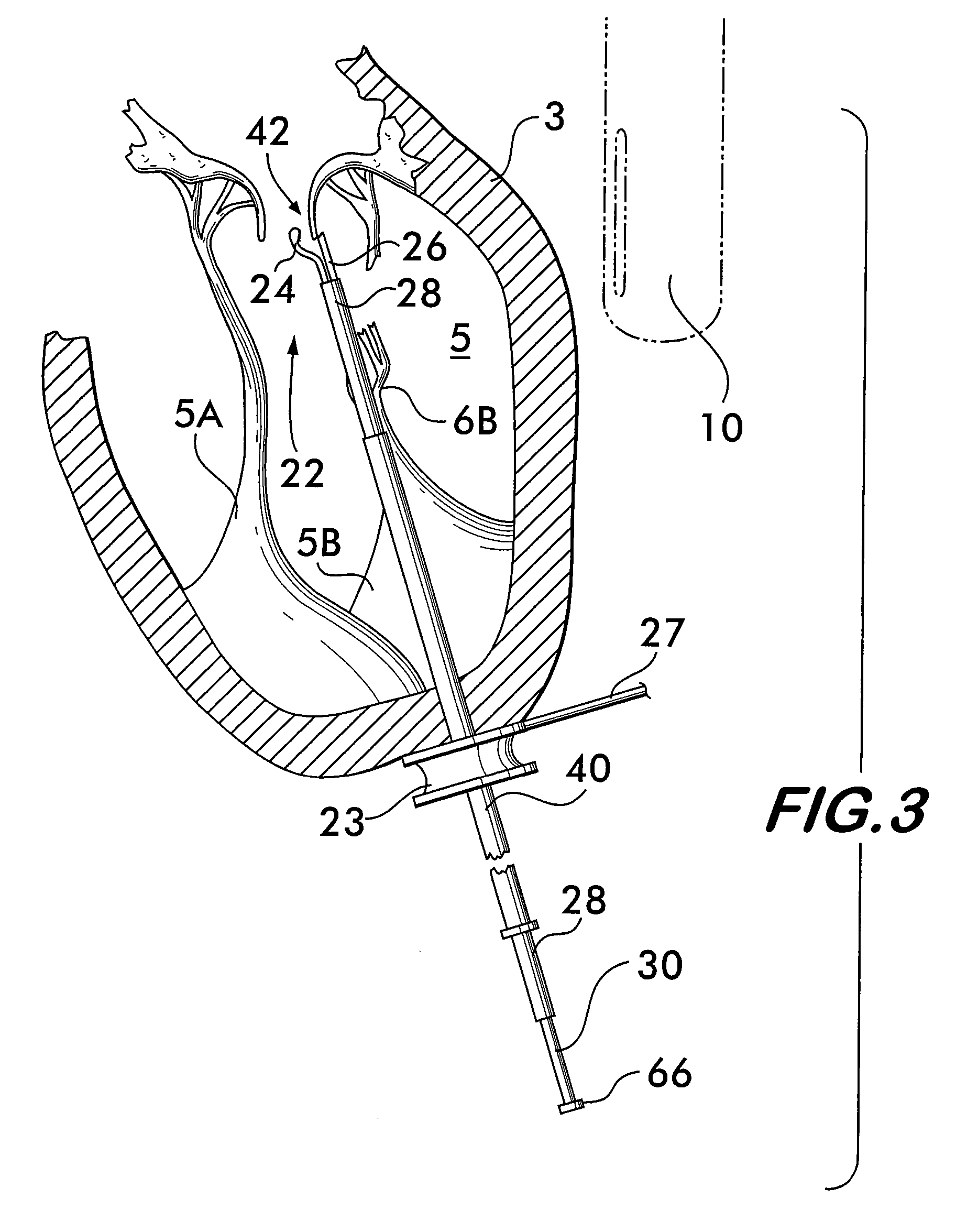Apparatus and method for mitral valve repair without cardiopulmonary bypass, including transmural techniques