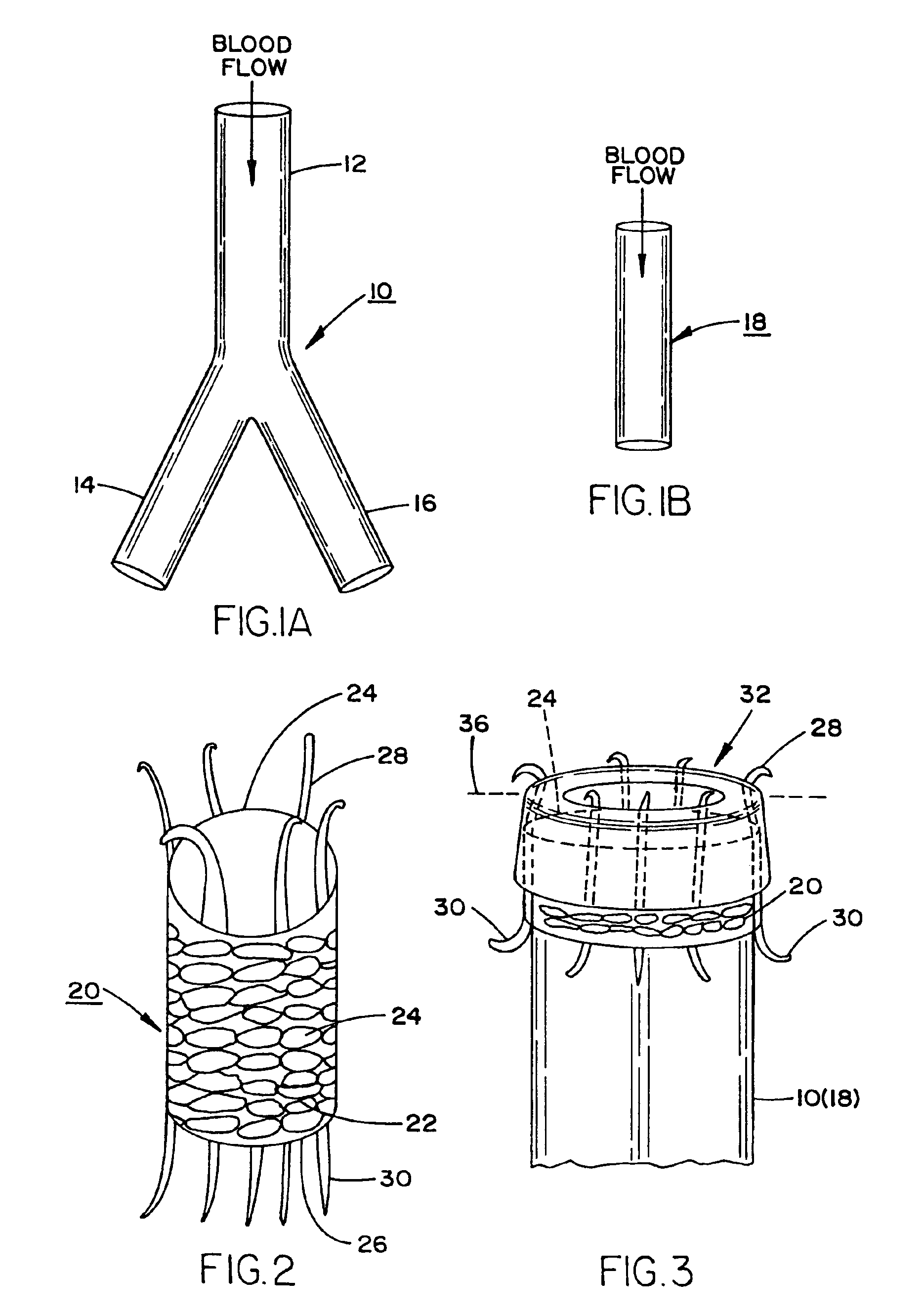 Prosthesis for the repair of thoracic or abdominal aortic aneurysms and method therefor