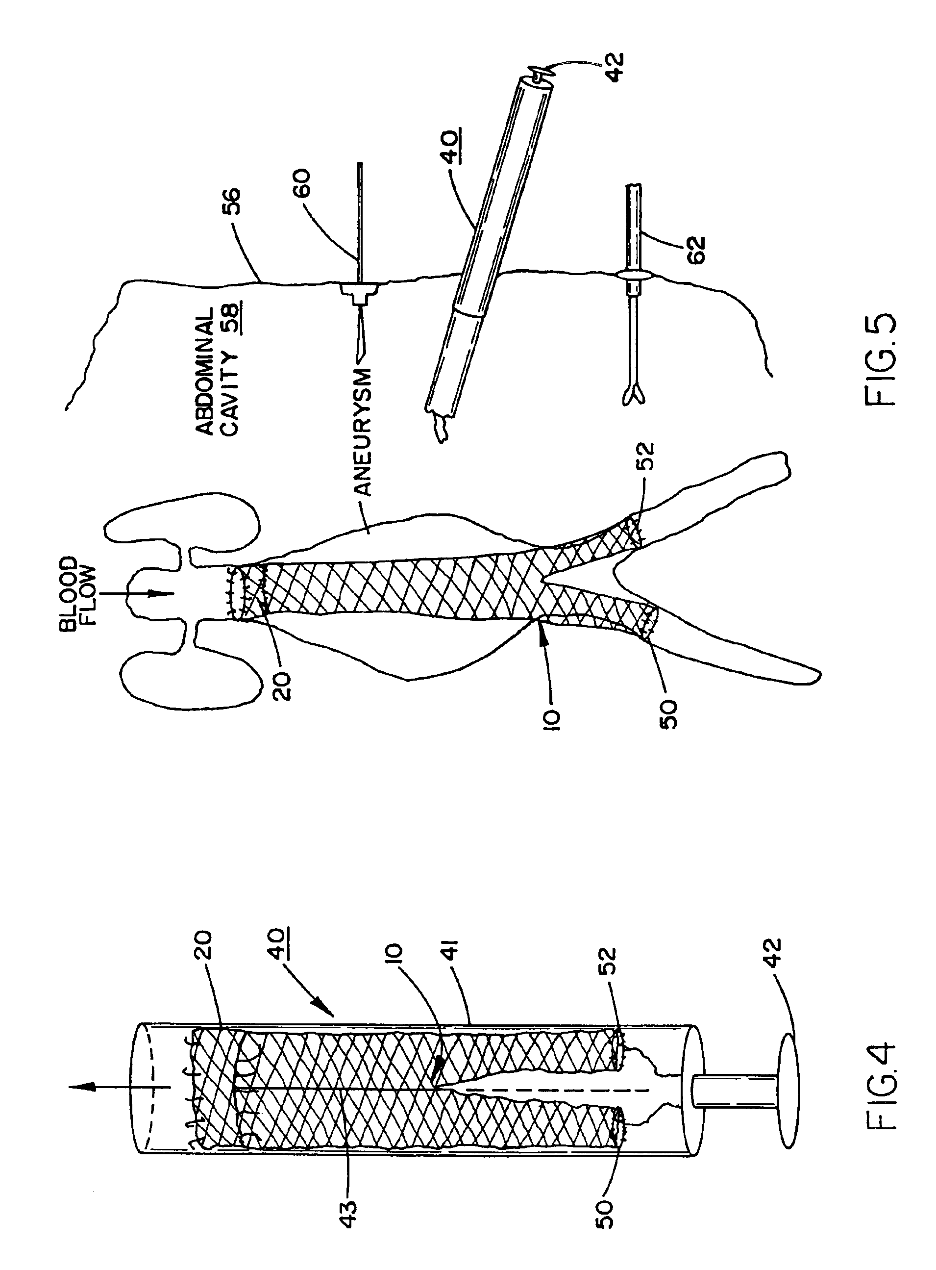 Prosthesis for the repair of thoracic or abdominal aortic aneurysms and method therefor