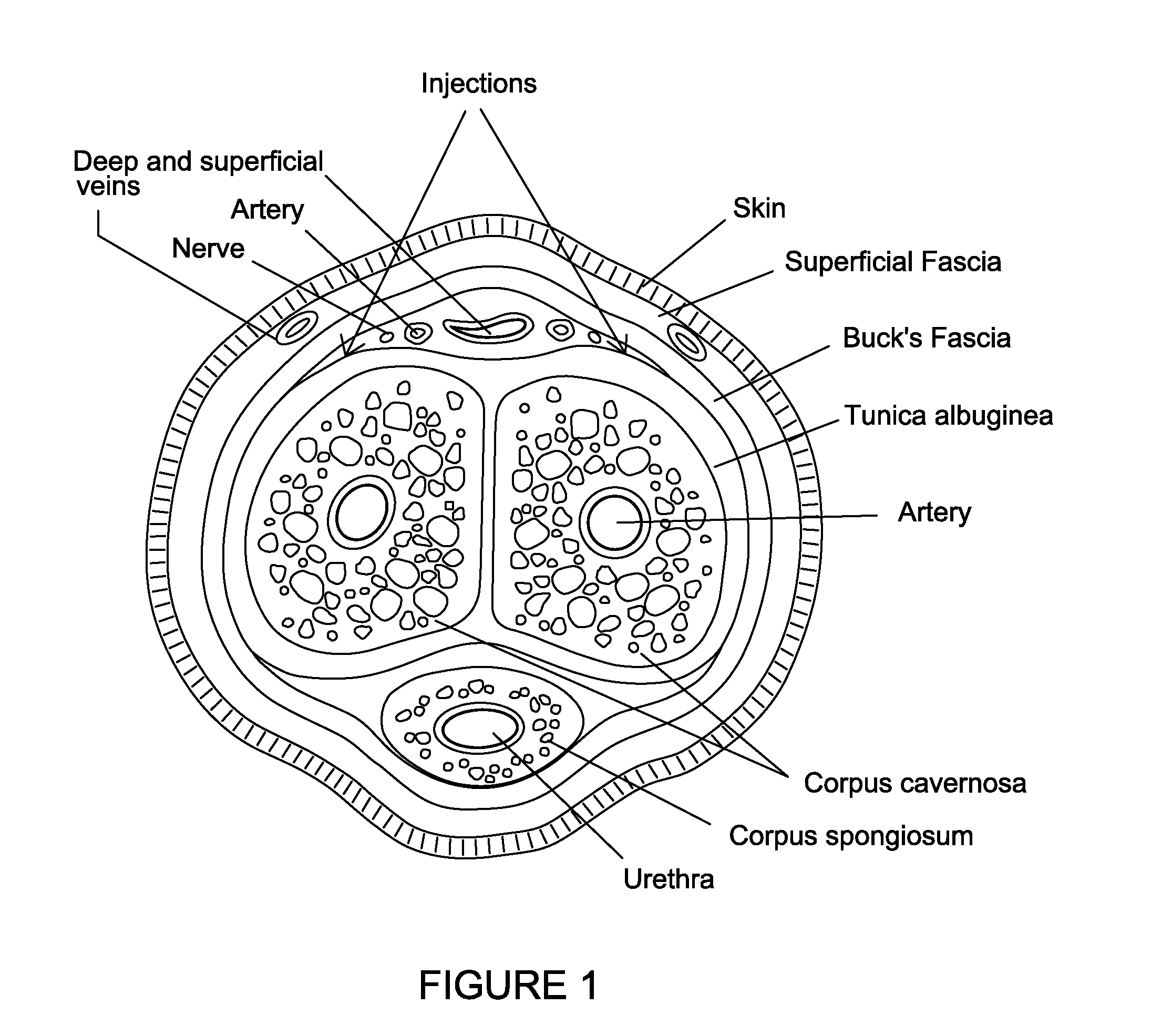 Method for treating premature ejaculation with a neurotoxin