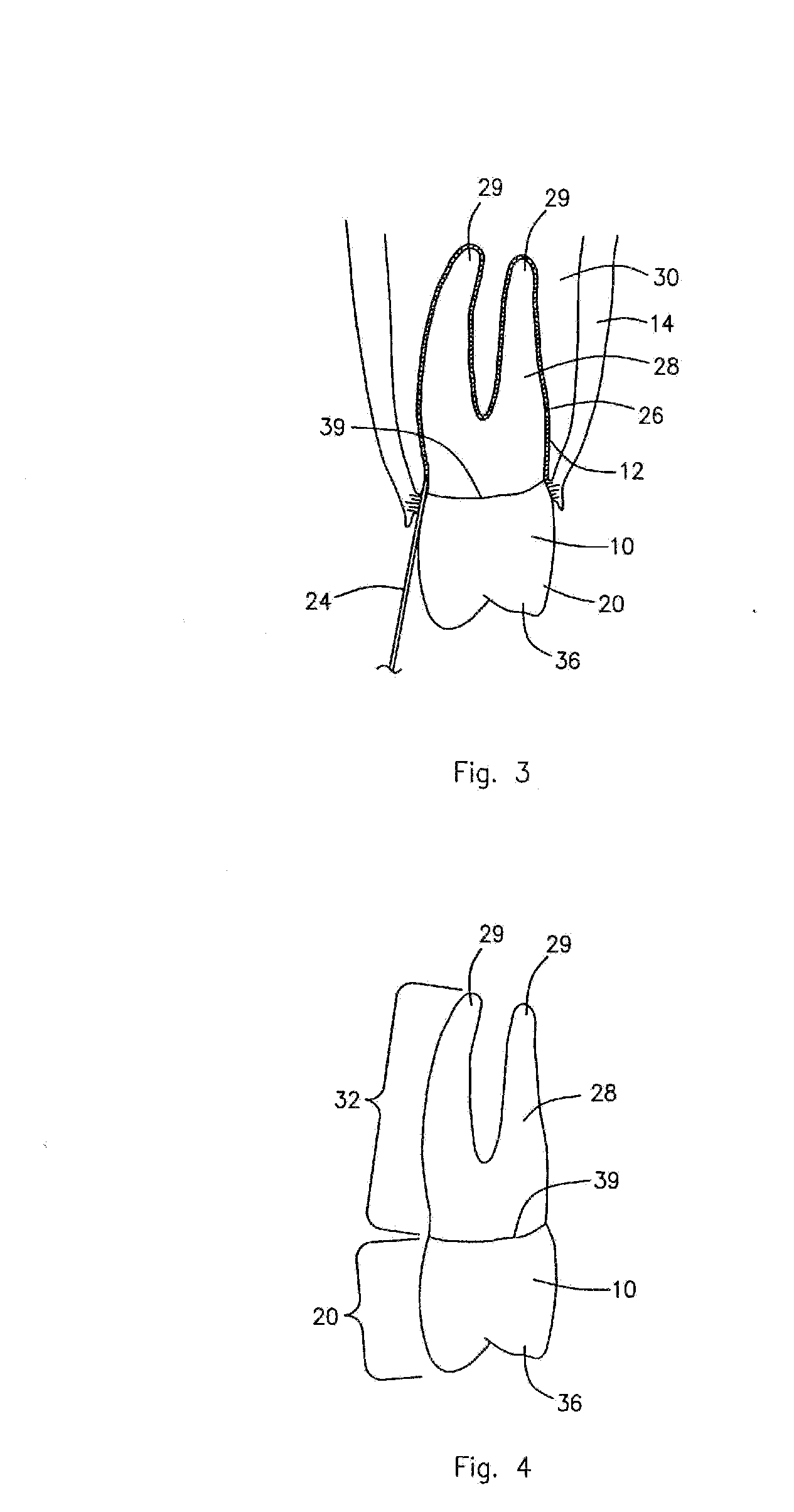 Dental implant and method for making and installing same