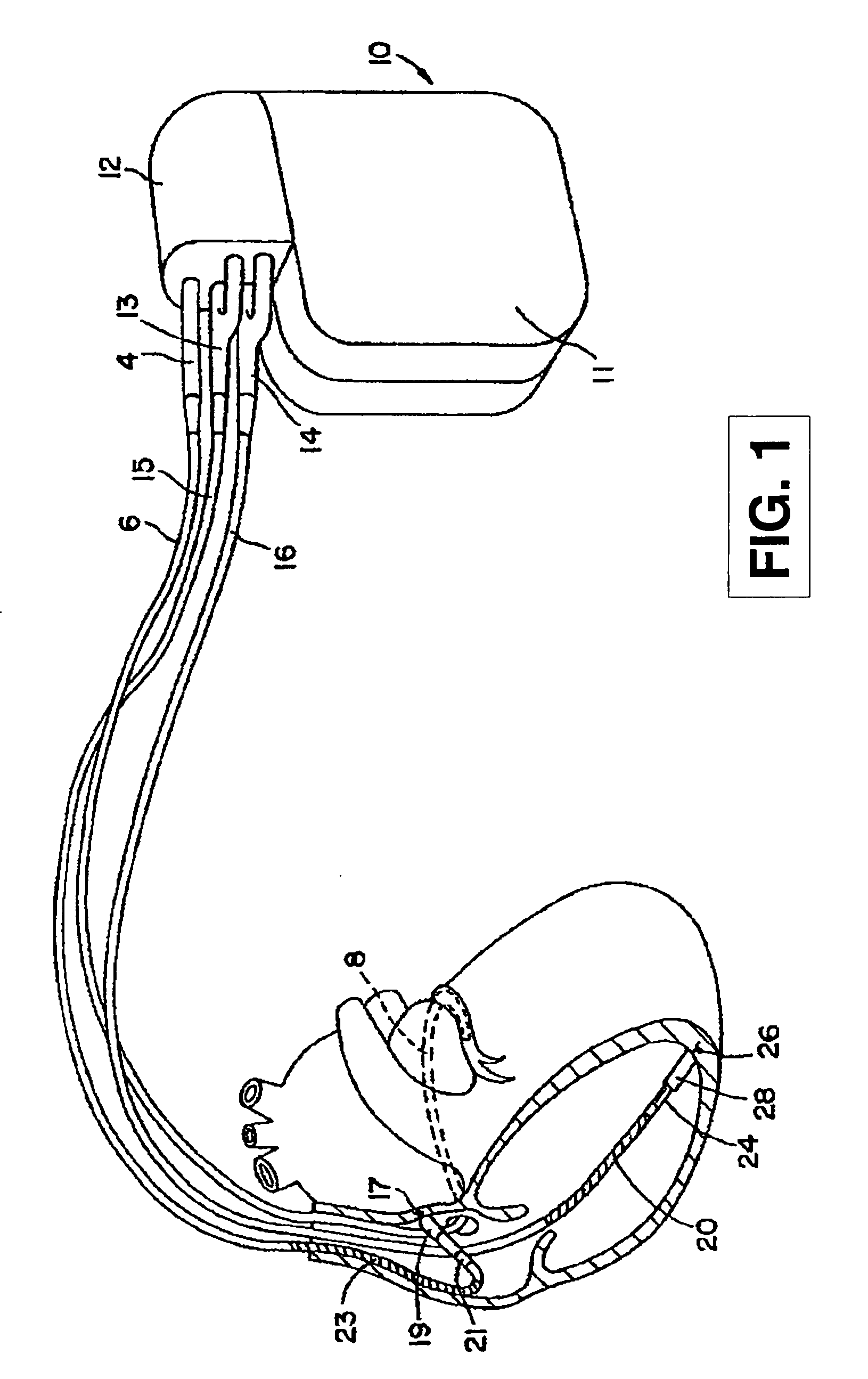 Method and apparatus for detecting and discriminating arrhythmias