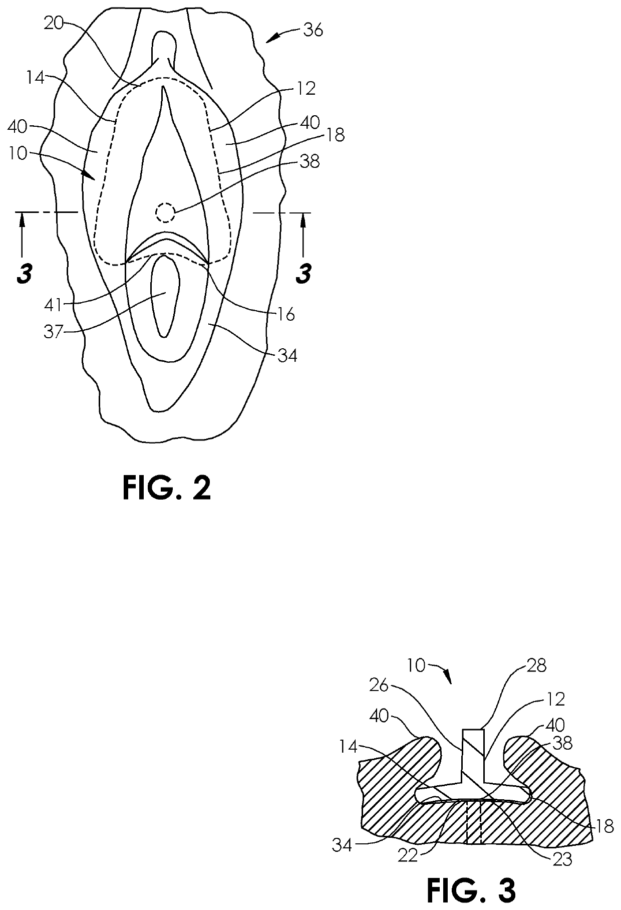 Systems and methods for incontinence control