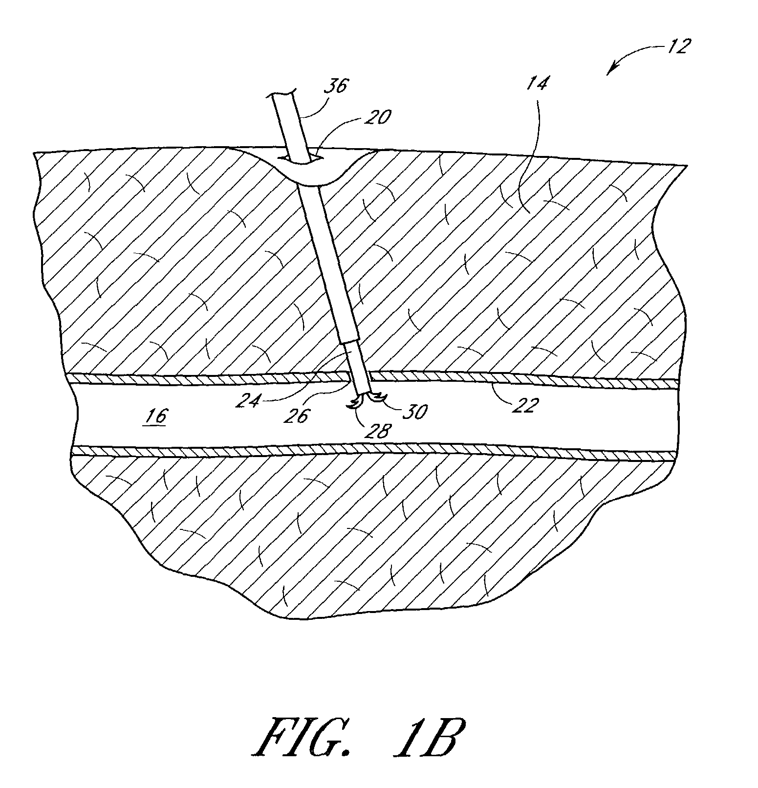 Suturing device and method for sealing an opening in a blood vessel for other biological structure