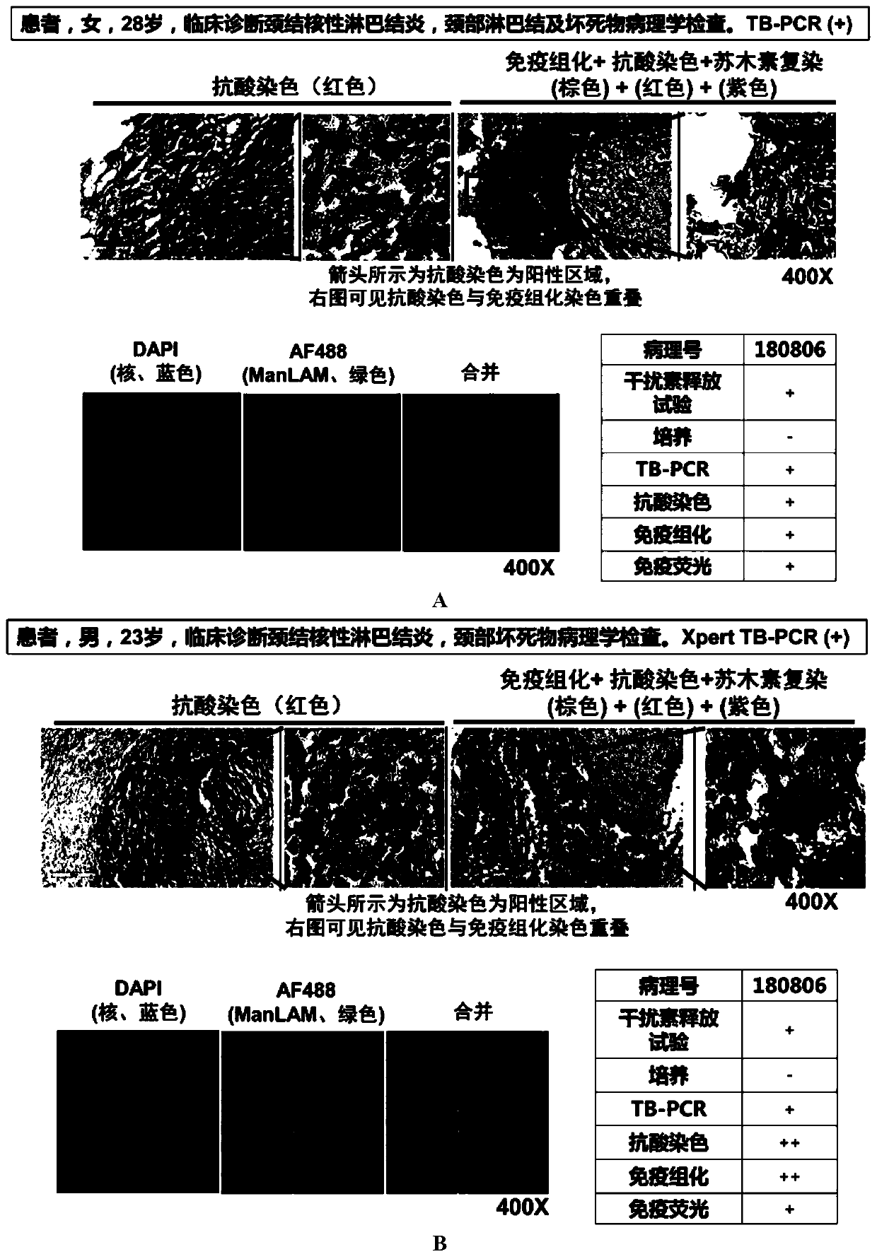 Application of tuberculosis immunohistochemical kit in diagnosis of tuberculosis pathological tissues