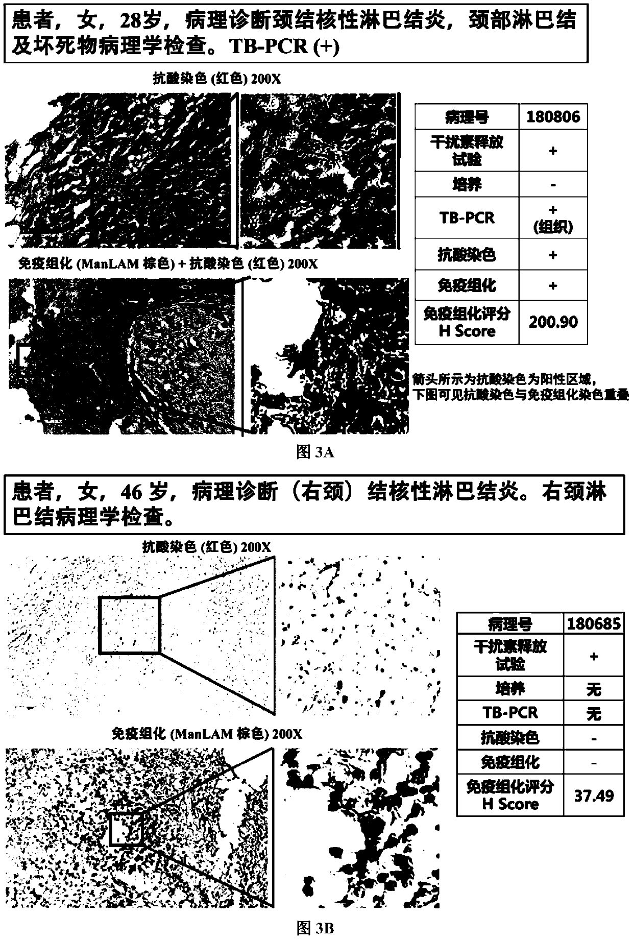 Application of tuberculosis immunohistochemical kit in diagnosis of tuberculosis pathological tissues
