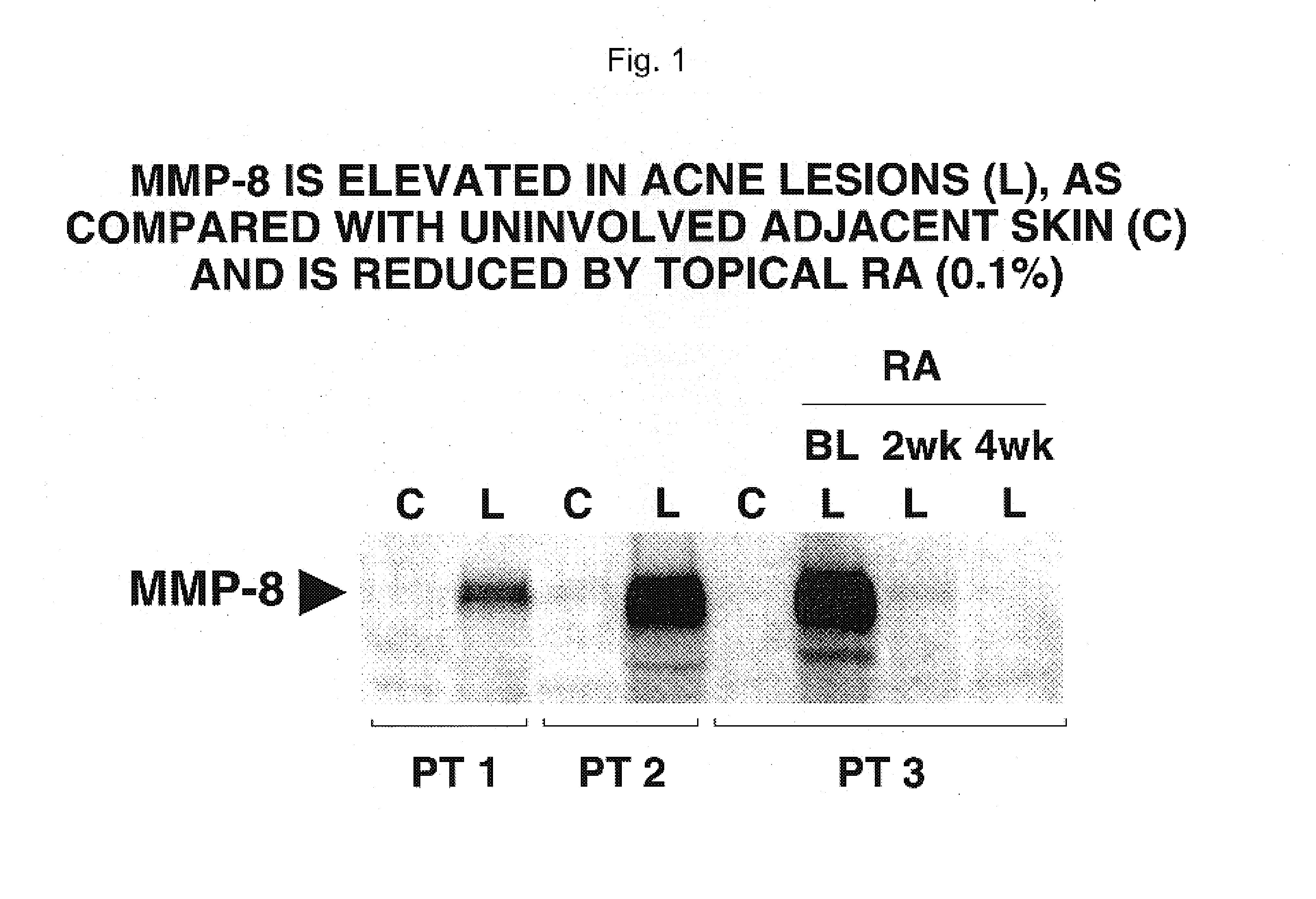 Compositions and methods for use against acne-induced inflammation and dermal matrix-degrading enzymes