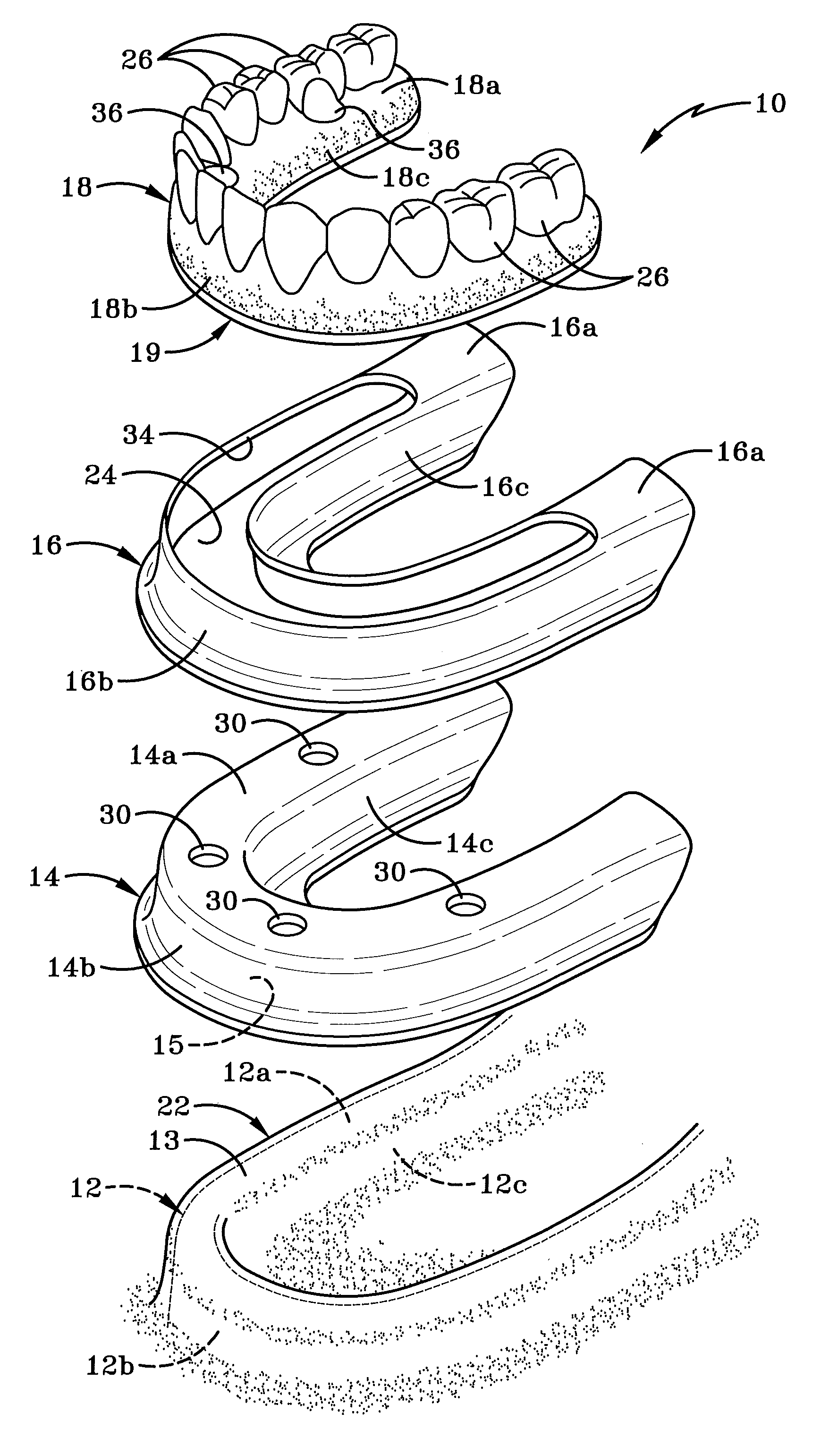 Cradle for positioning a final dental prosthesis and a system incorporating the cradle