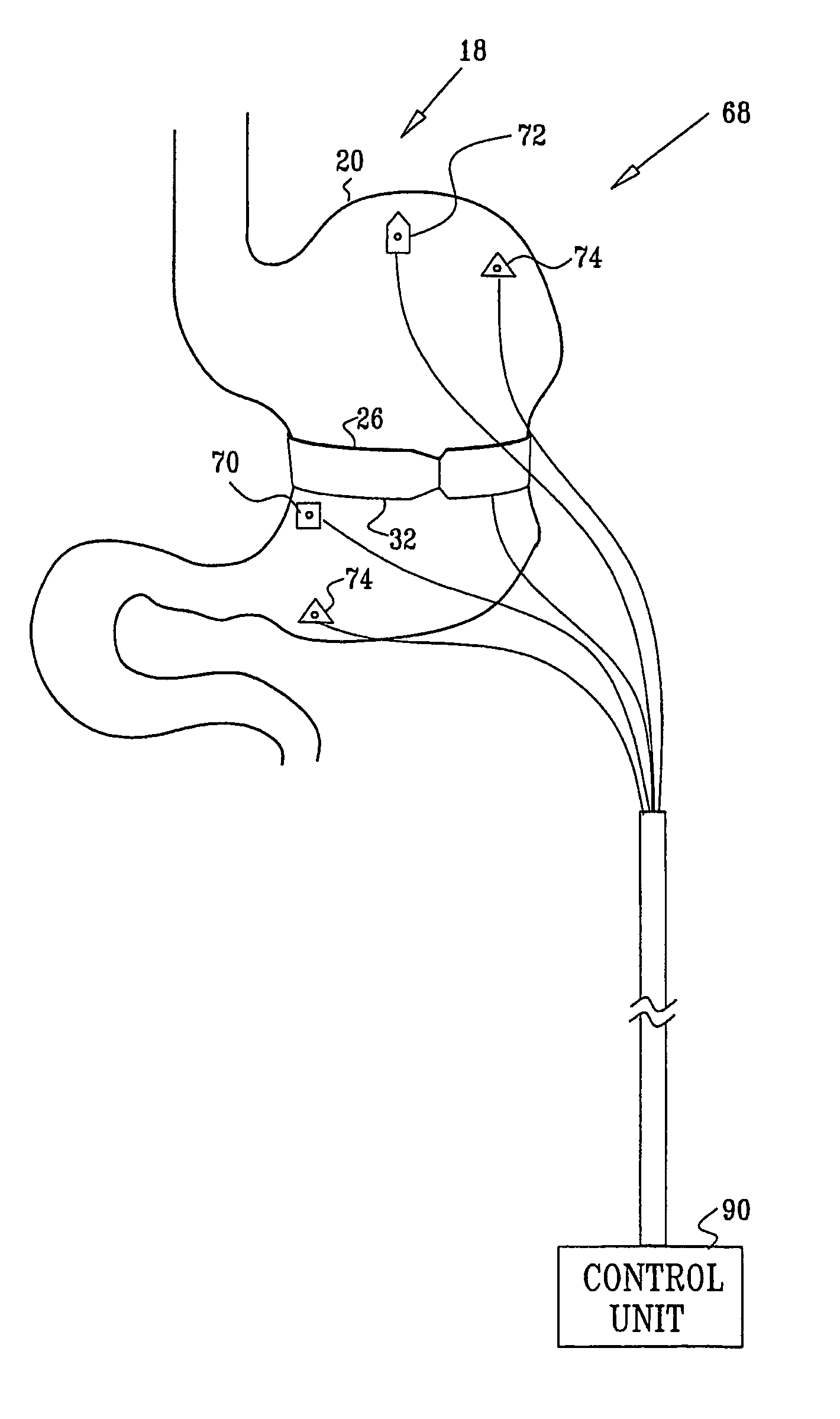 Gastrointestinal methods and apparatus for use in treating disorders and controlling blood sugar