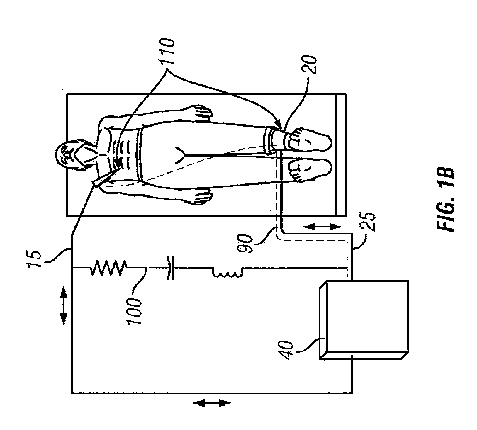Connection of a bipolar electrosurgical hand piece to a monopolar output of an electrosurgical generator