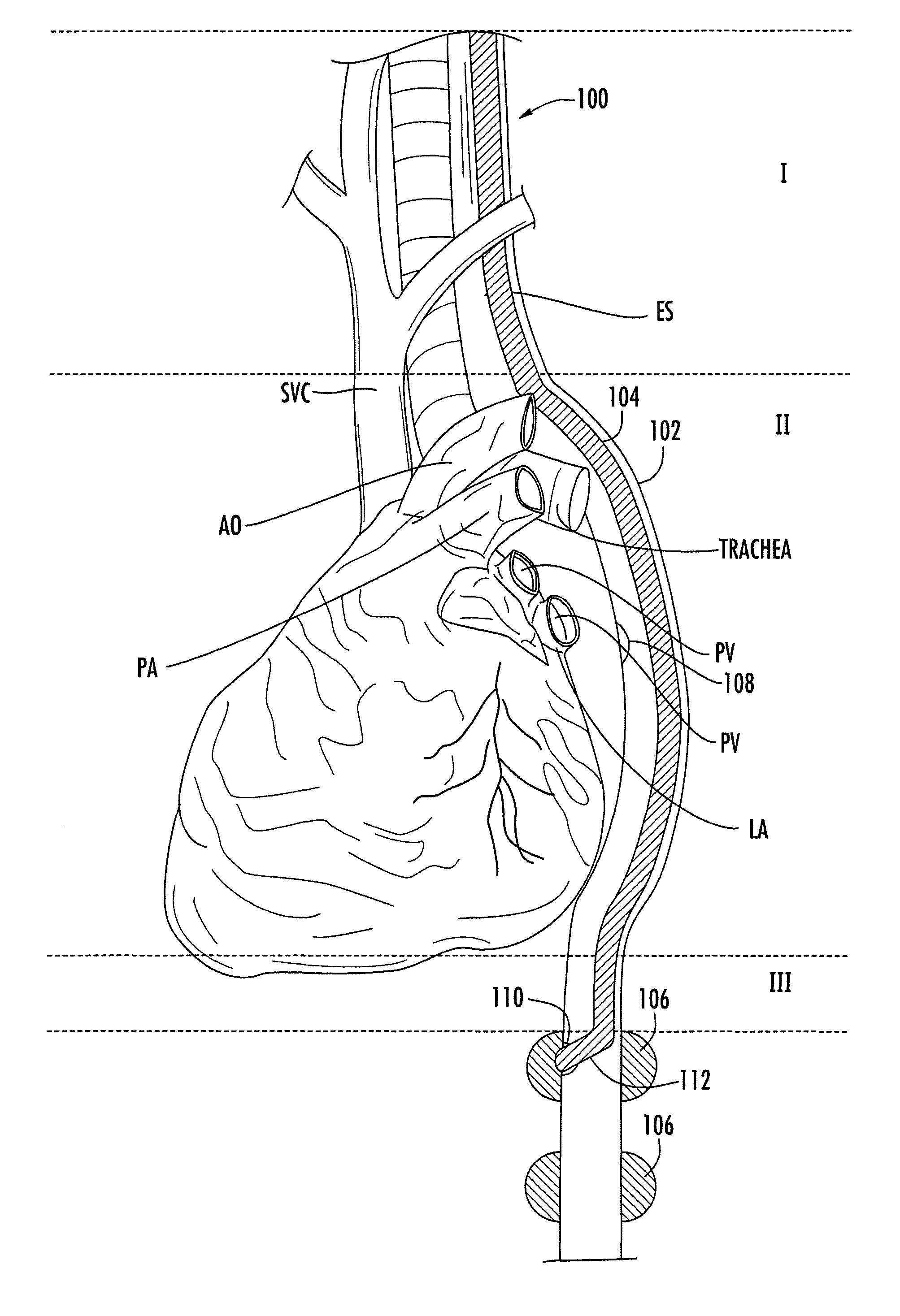 Nasogastric tube for use during an ablation procedure
