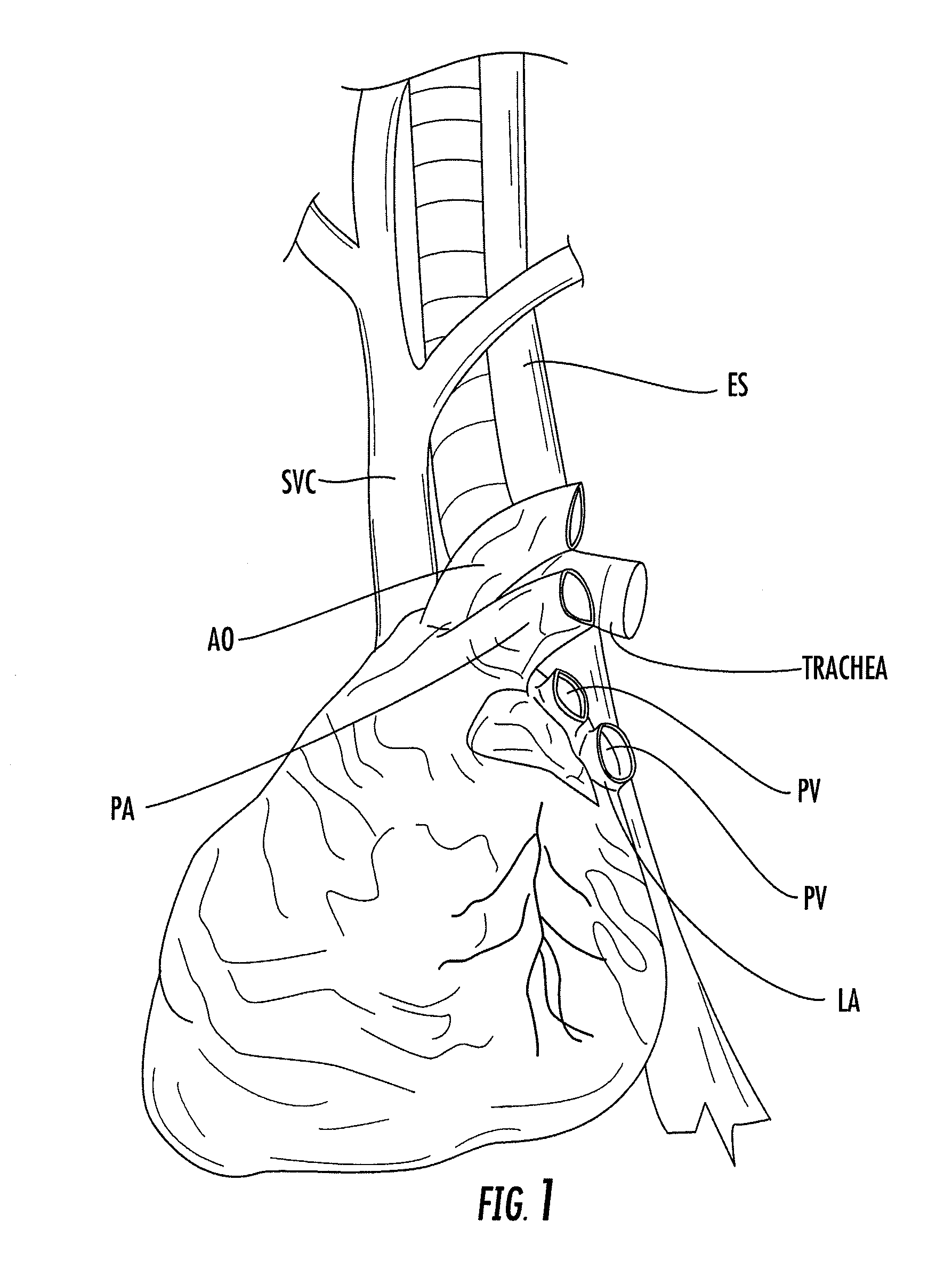 Nasogastric tube for use during an ablation procedure