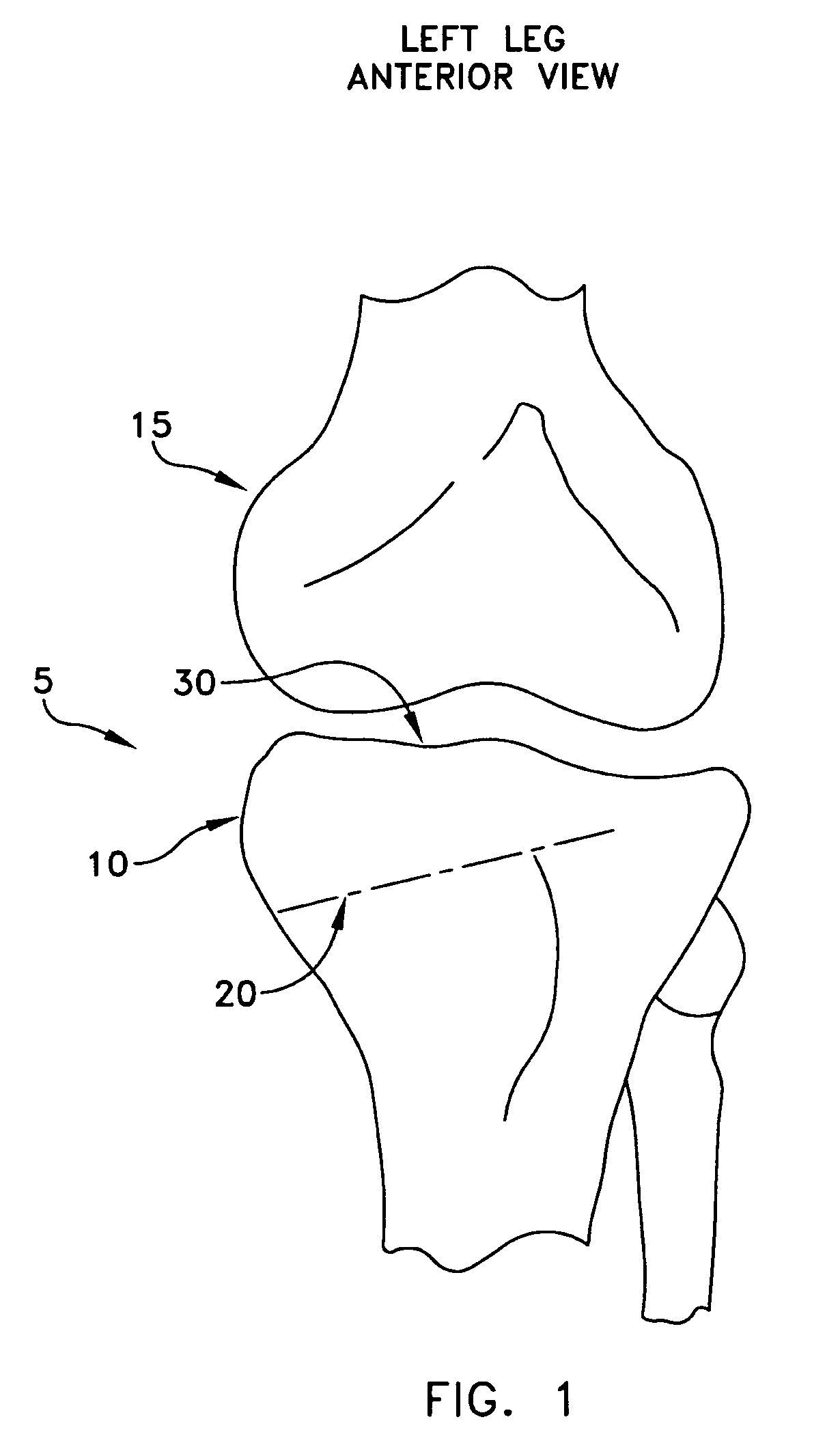 Method and apparatus for forming a wedge-like opening in a bone for an open wedge osteotomy