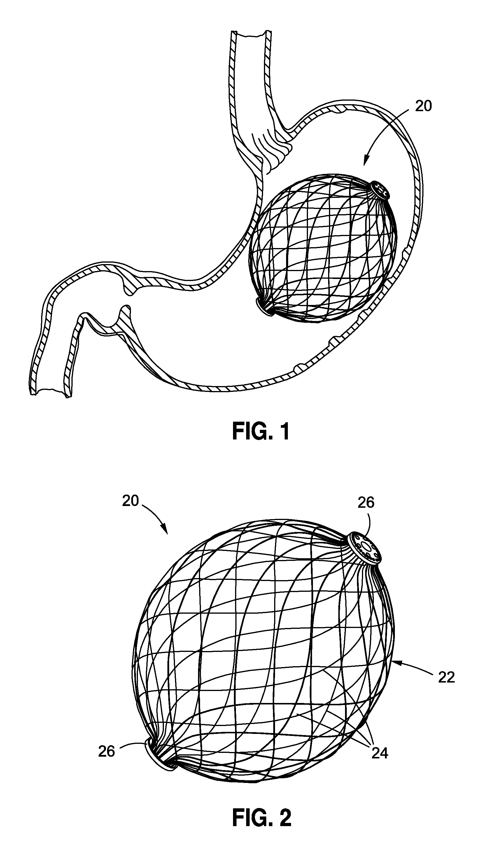 Intragastric implants with collapsible frames
