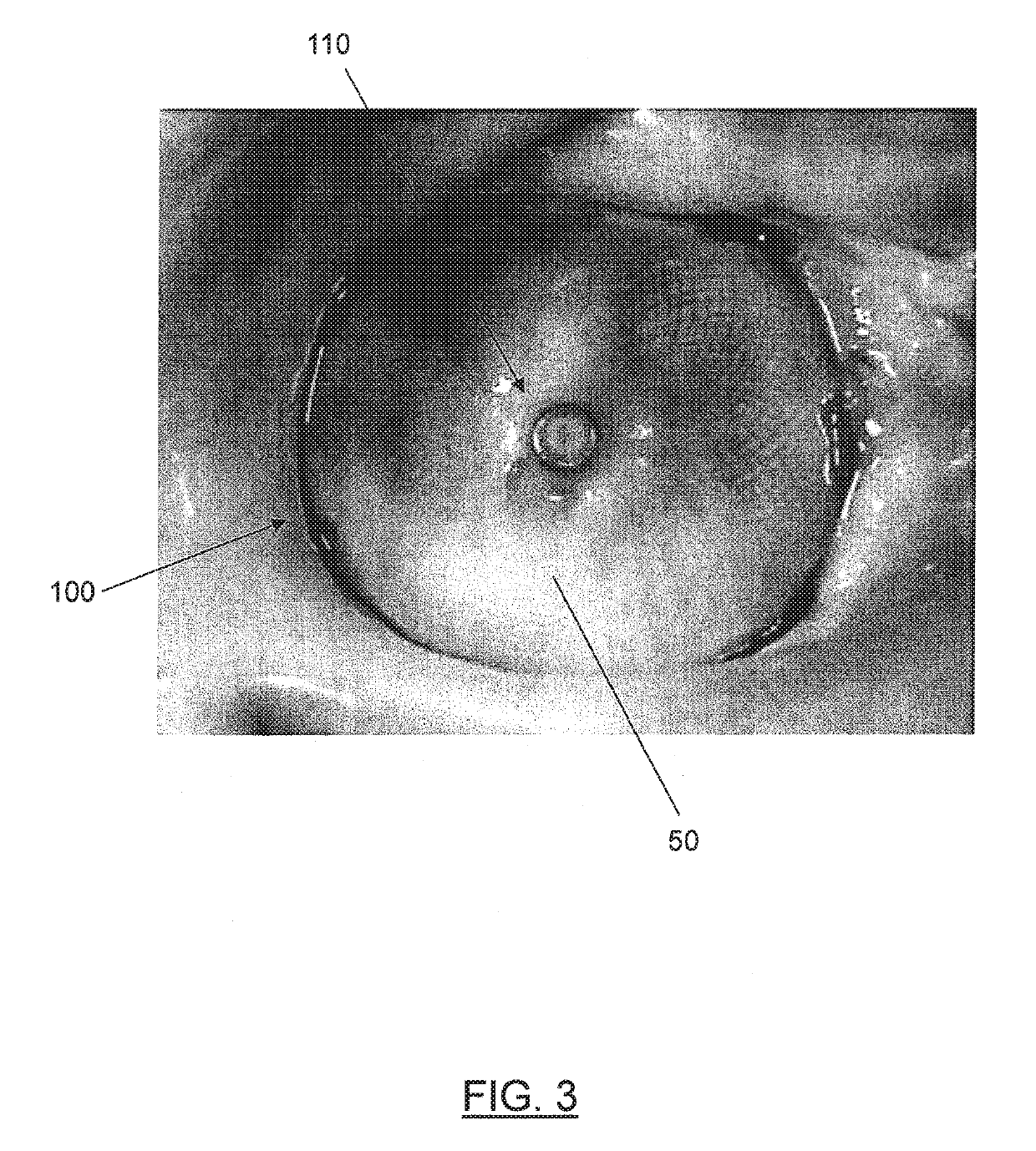 Percutaneous catheter directed intravascular occlusion devices with retractable stabilizing wires