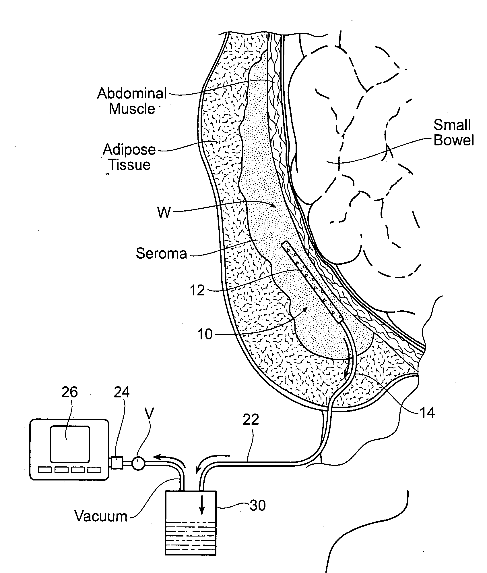 Assemblies, systems, and methods for vacuum assisted internal drainage during wound healing