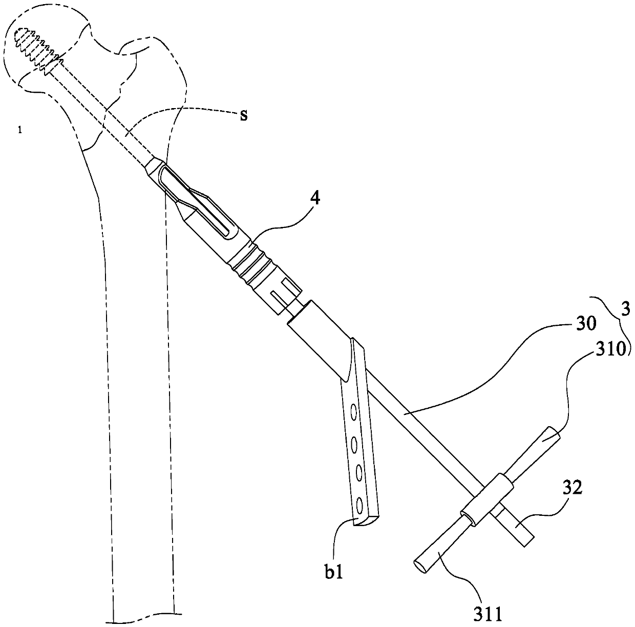 Proximal femoral fracture repair auxiliary combination device and auxiliary components thereof