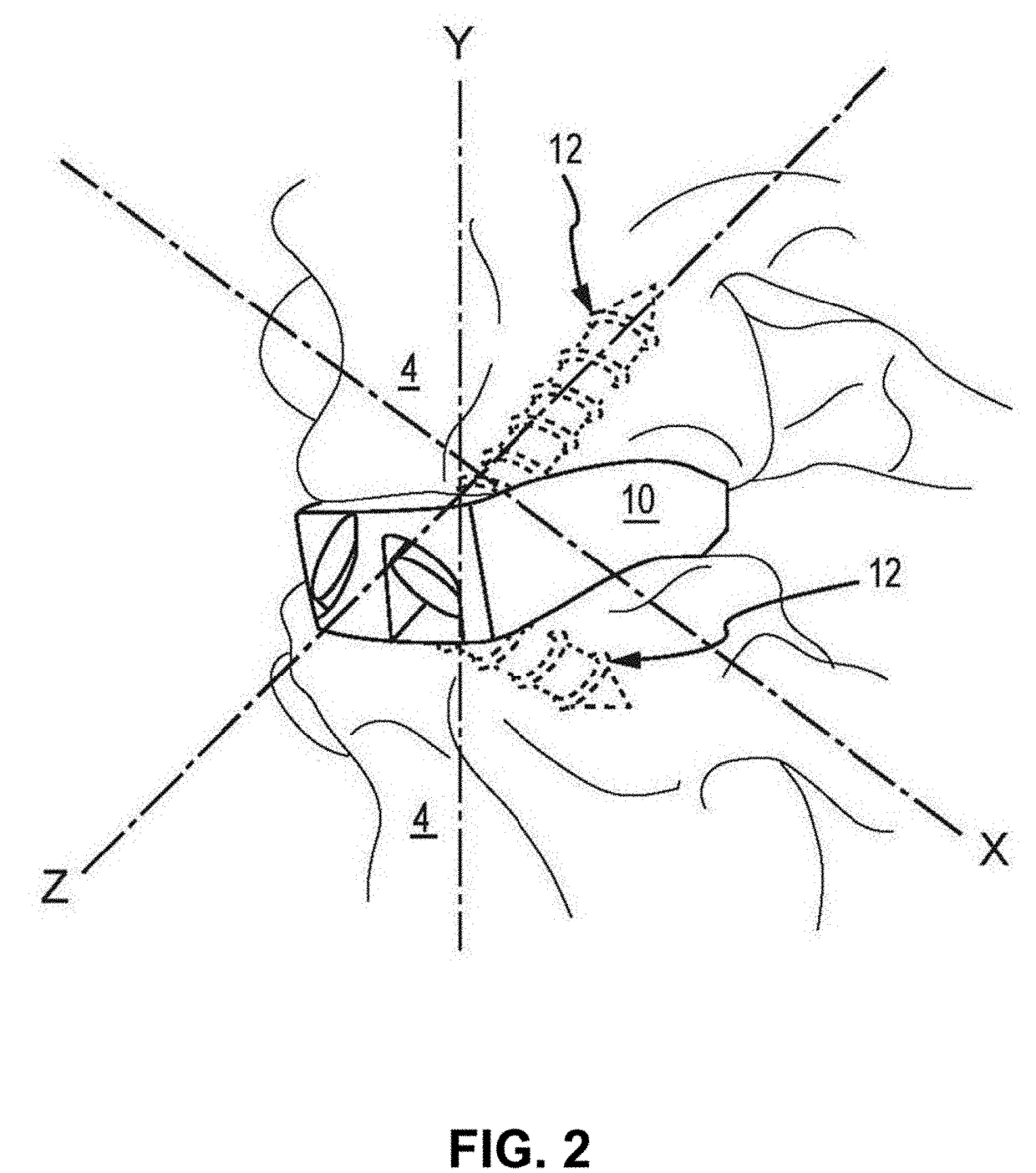 Acif cage, cage system and method