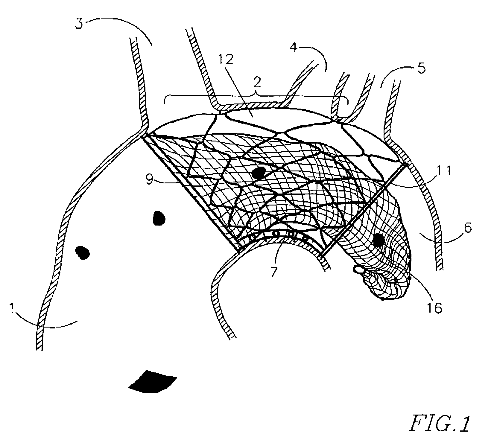 Endovascular device for entrapment of particulate matter and method for use