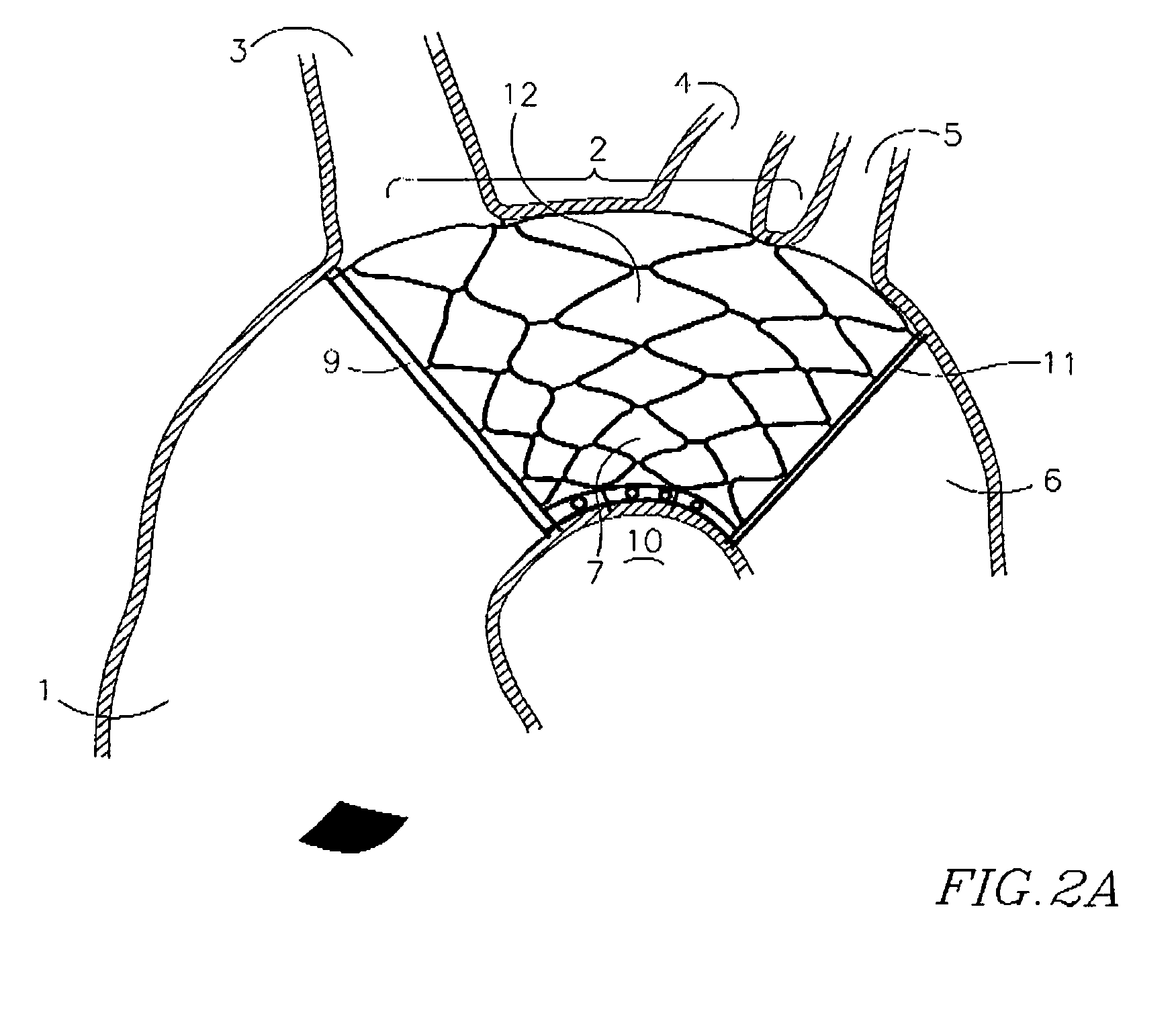 Endovascular device for entrapment of particulate matter and method for use