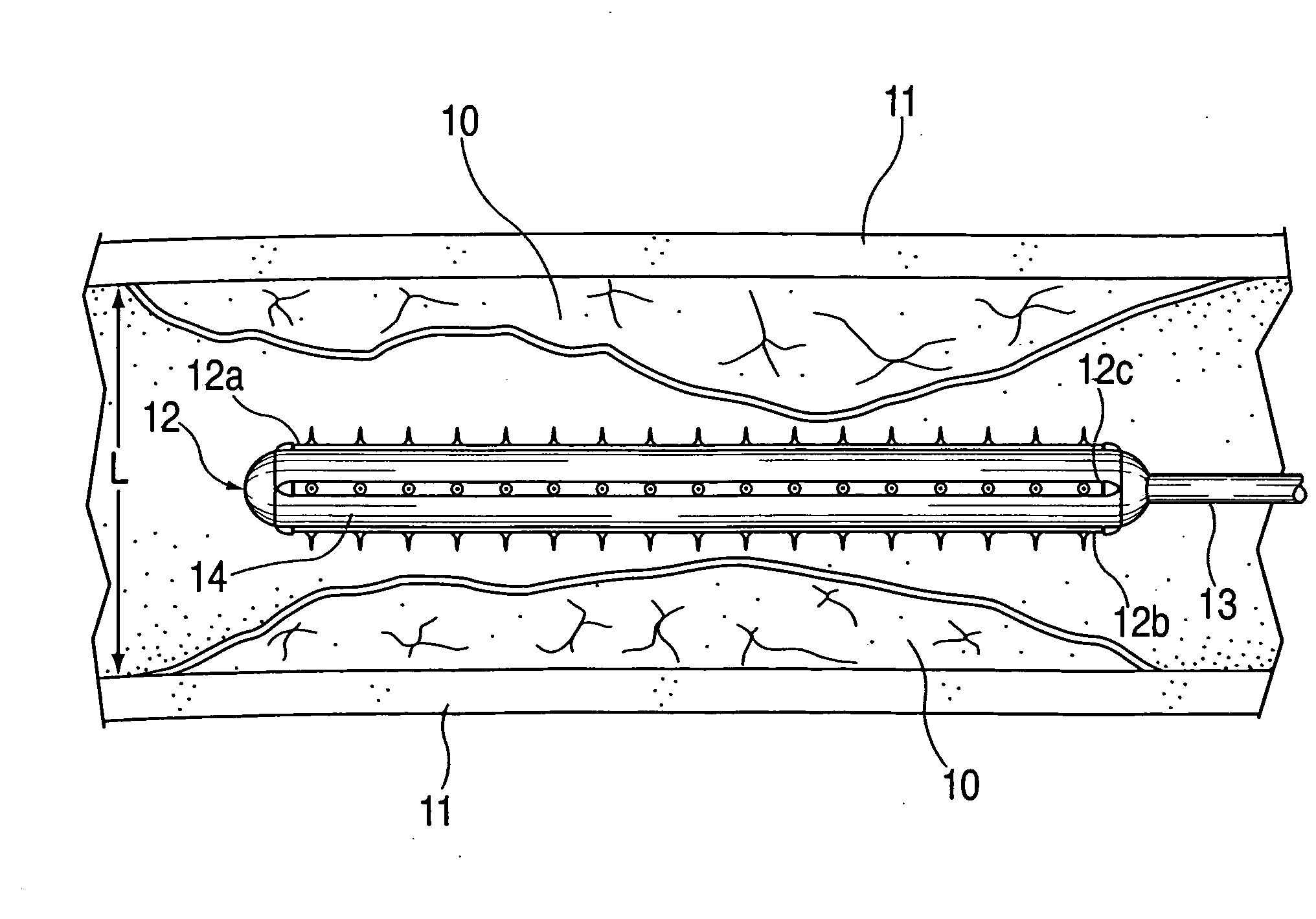 Device and method for opening blood vessels by pre-angioplasty serration and dilatation of atherosclerotic plaque