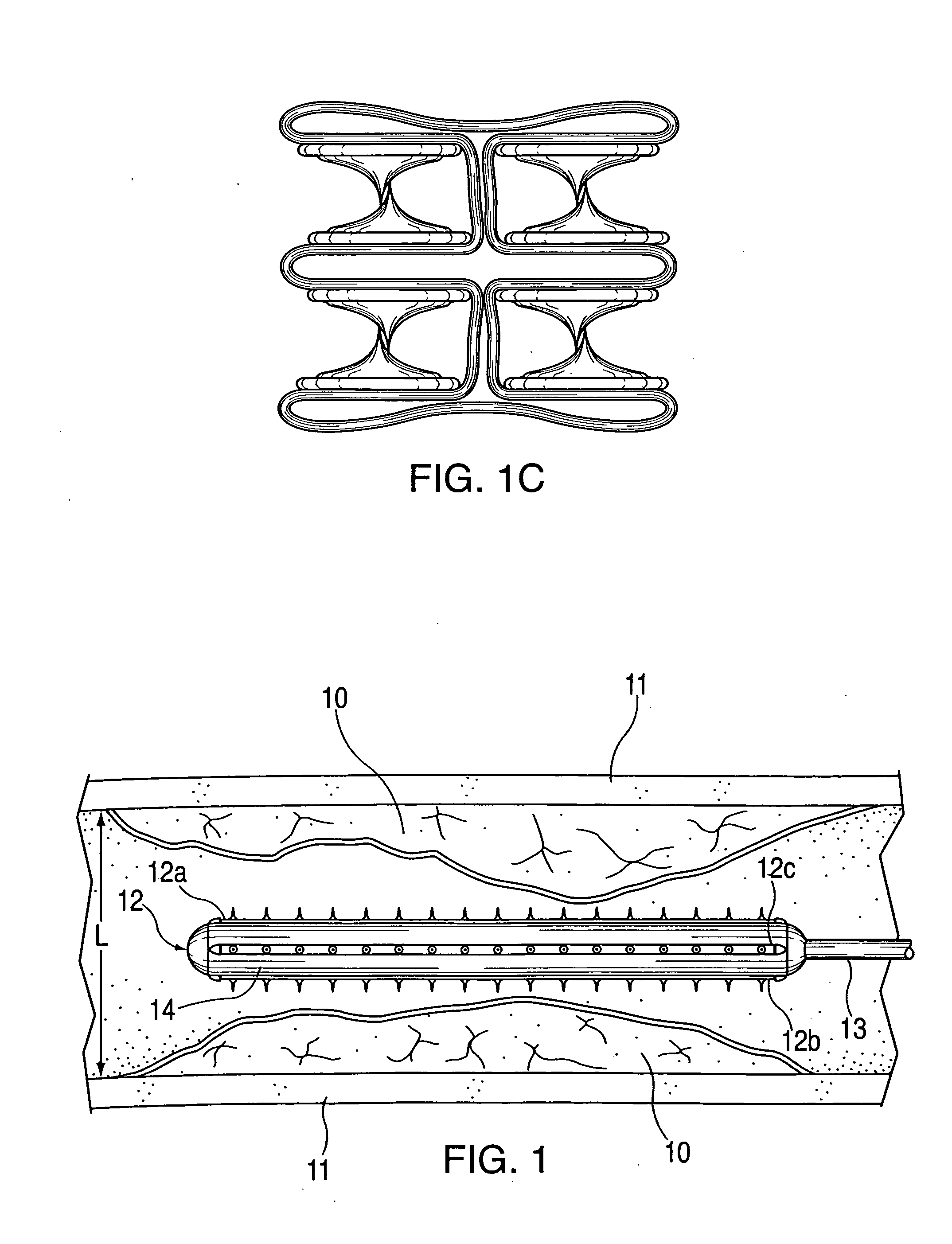 Device and method for opening blood vessels by pre-angioplasty serration and dilatation of atherosclerotic plaque