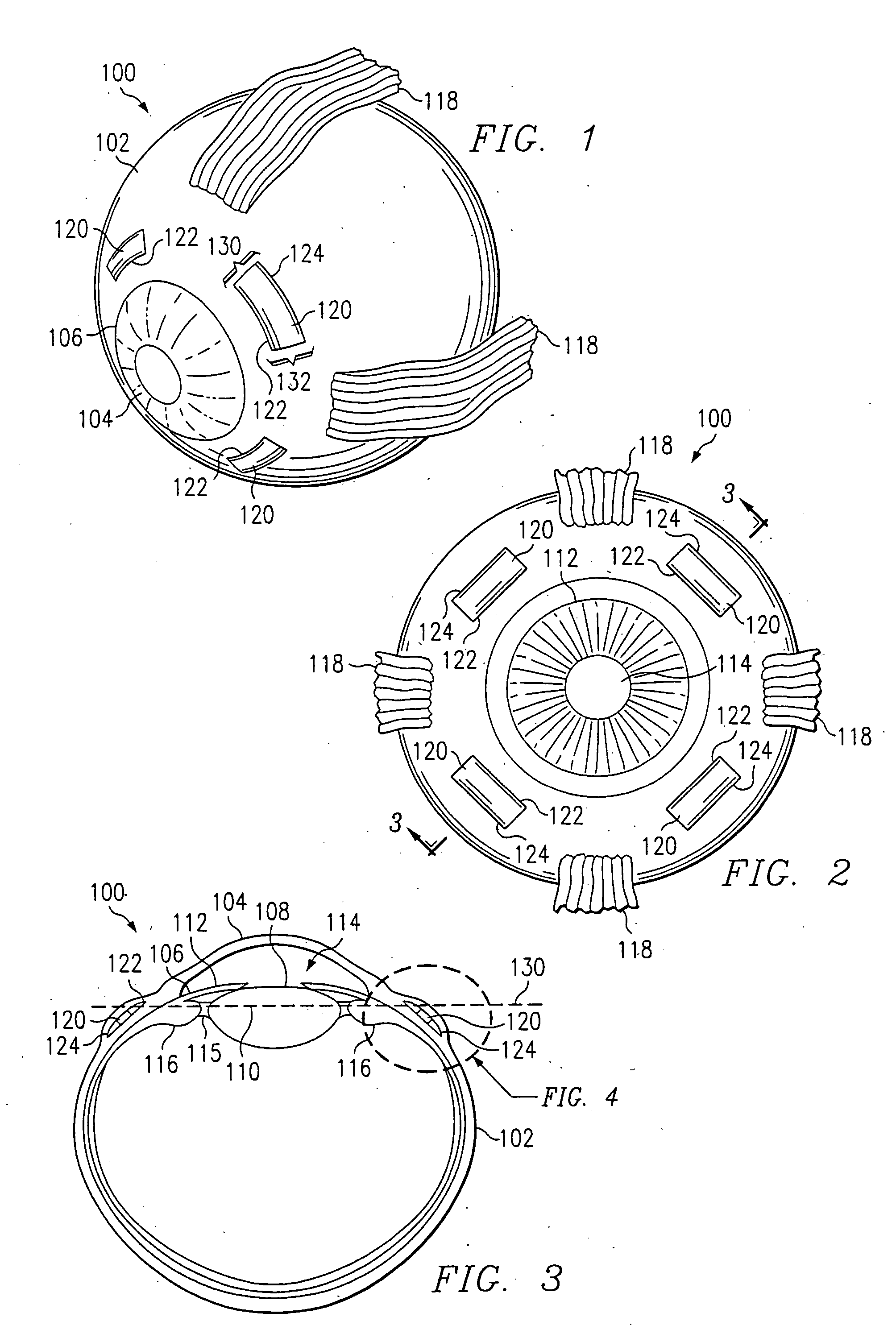 System and method for making incisions for scleral eye implants