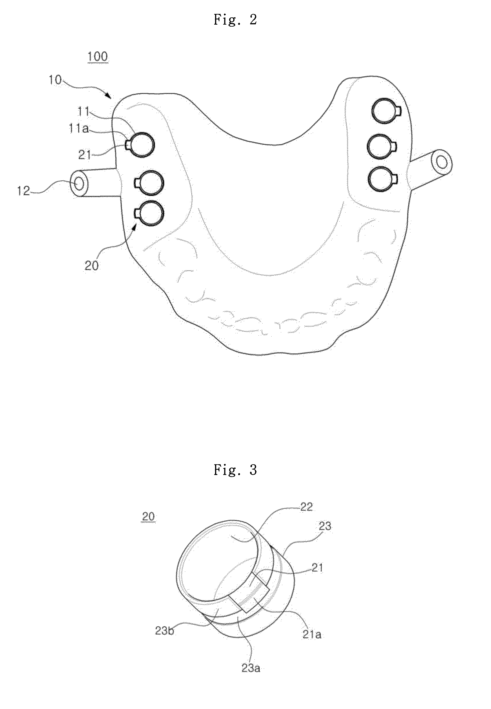 Dental implant insertion set and manufacturing method thereof