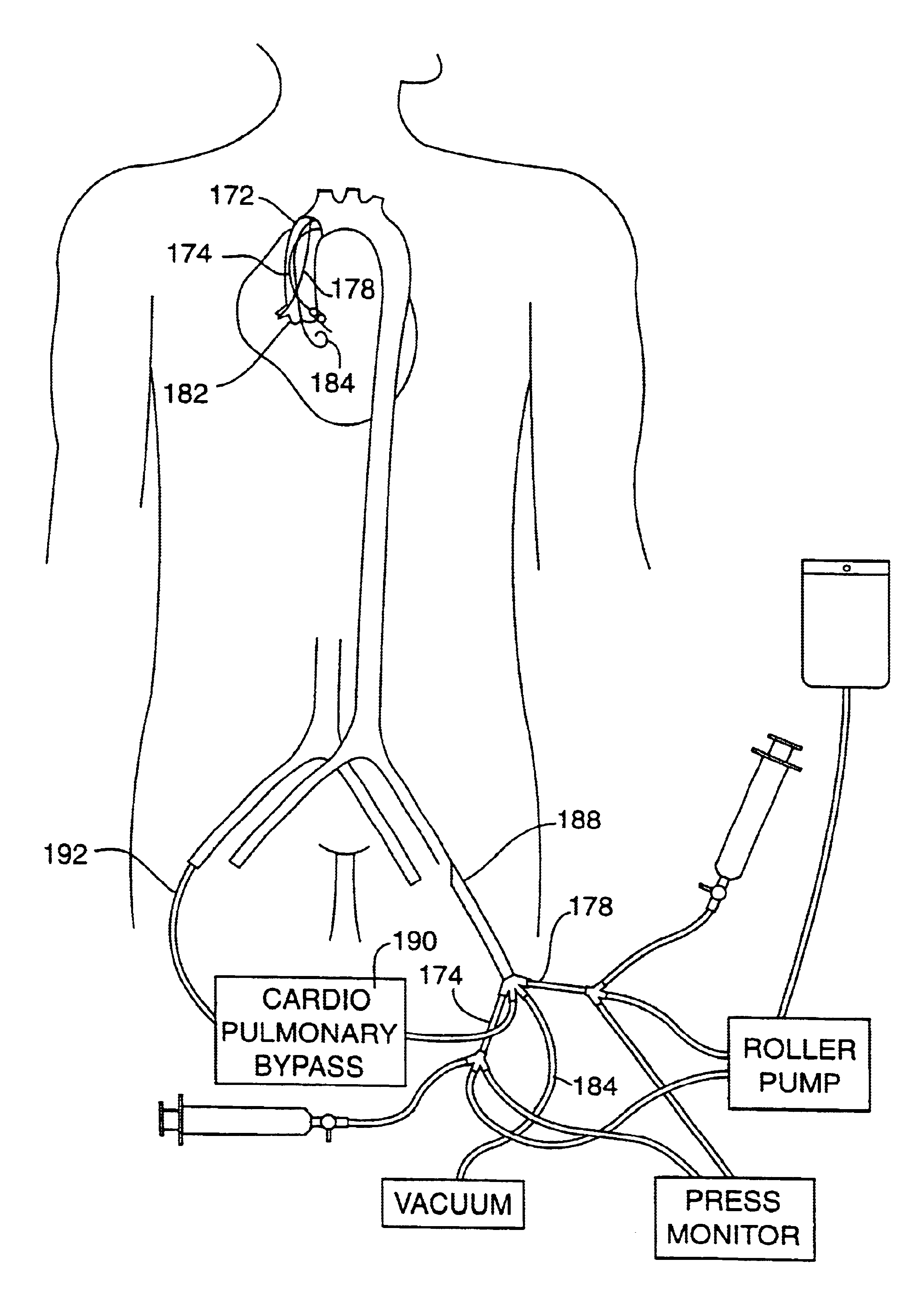 Method for delivering a fluid to the coronary ostia