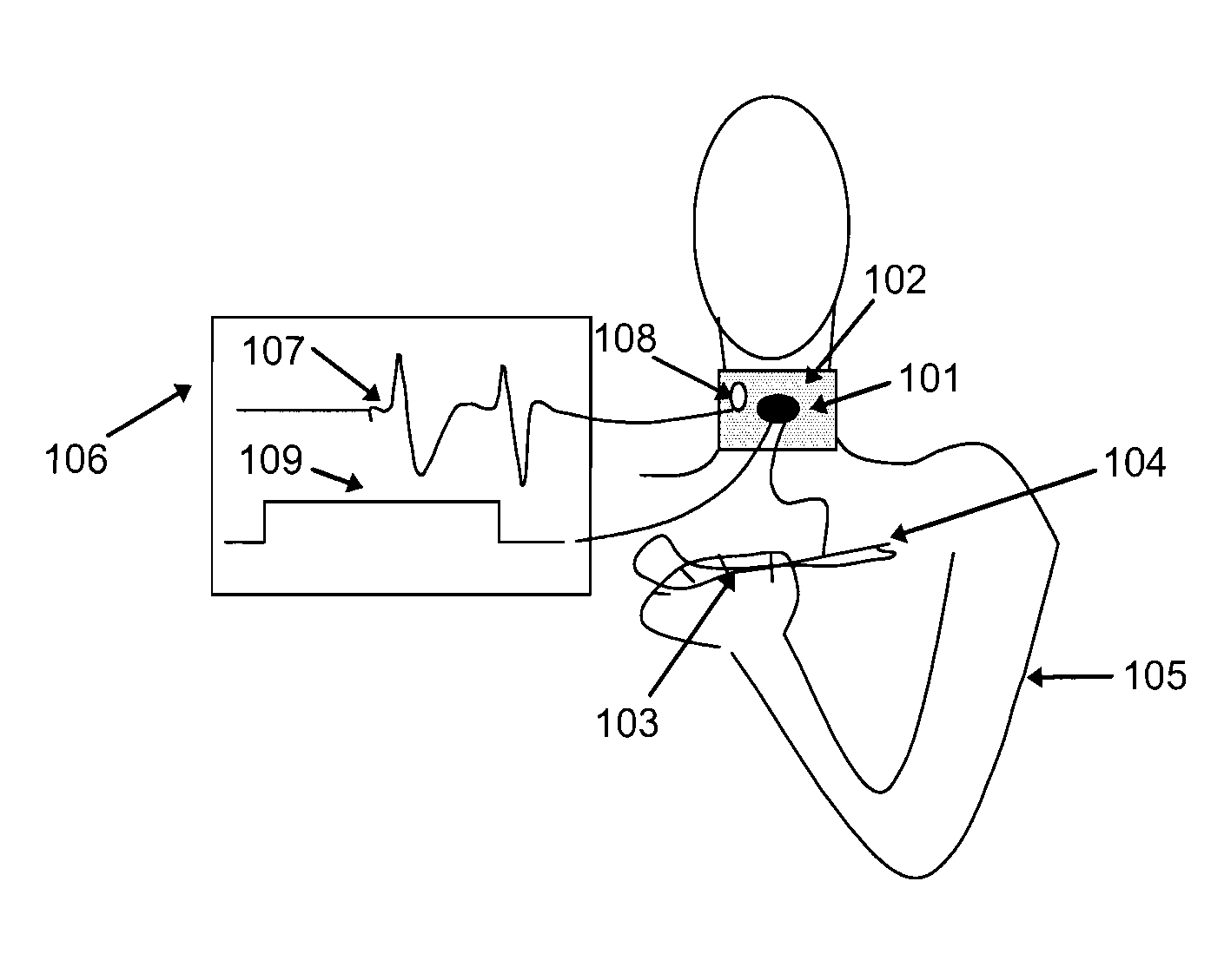 Device for Volitional Swallowing with a Substitute Sensory System