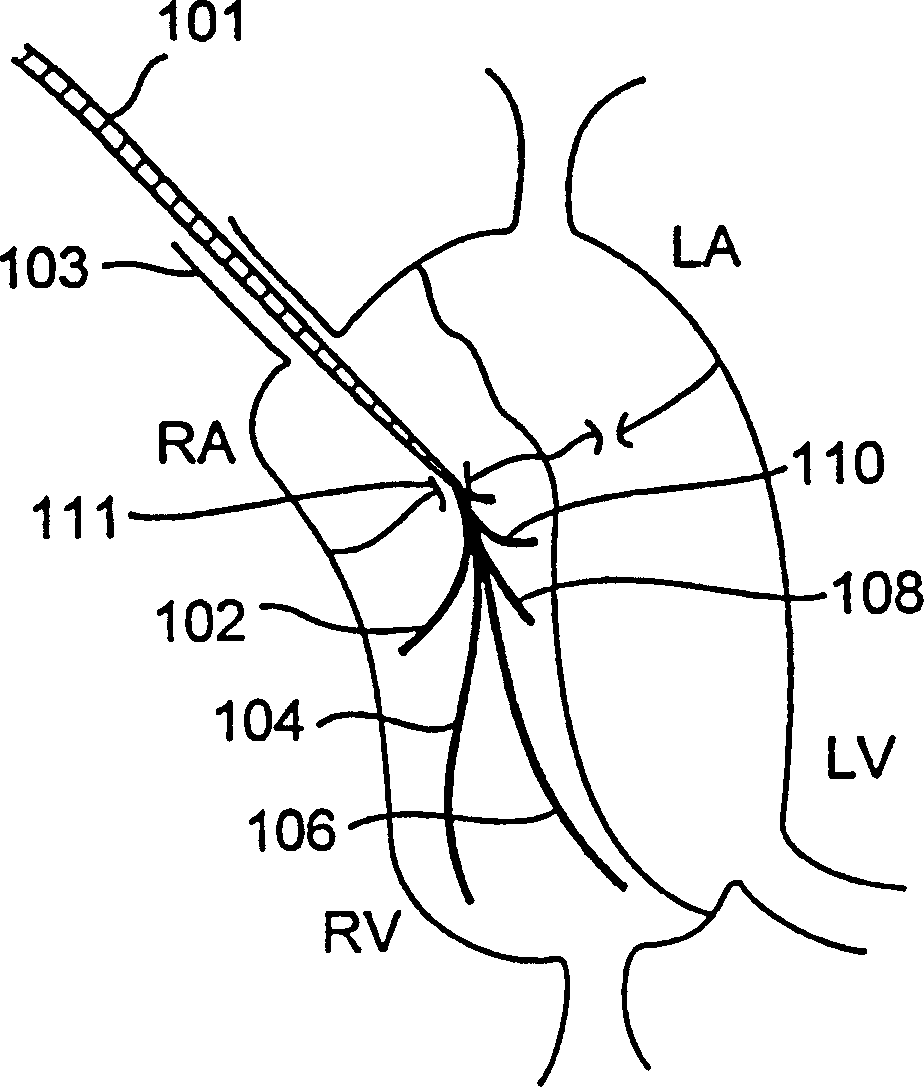 System and method for multiple site biphasic stimulation to restore ventricular arrhythmias