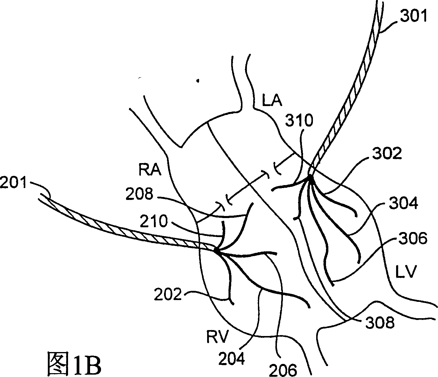 System and method for multiple site biphasic stimulation to restore ventricular arrhythmias