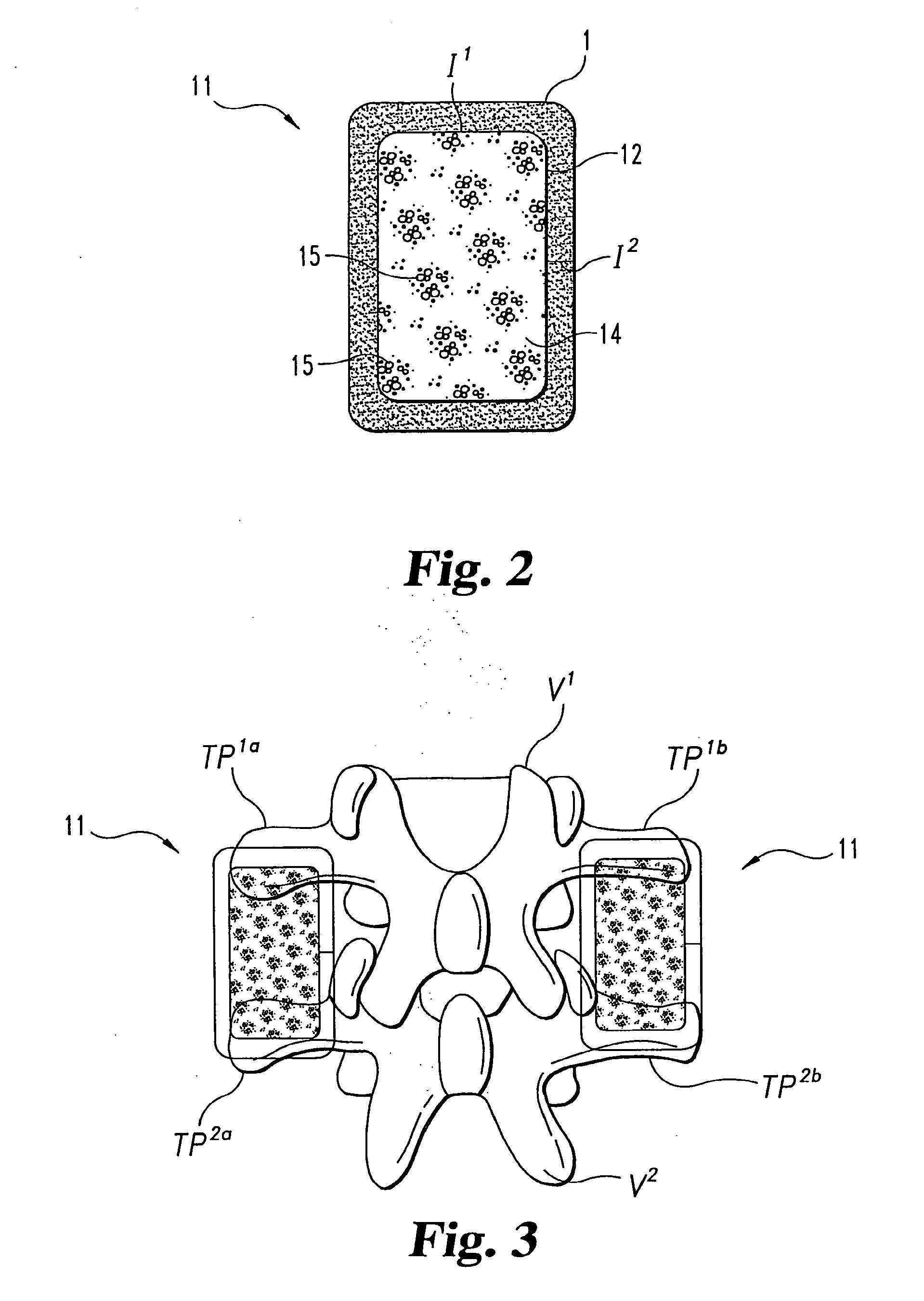 Osteogenic Implants with Combined Implant Materials and Methods for Same