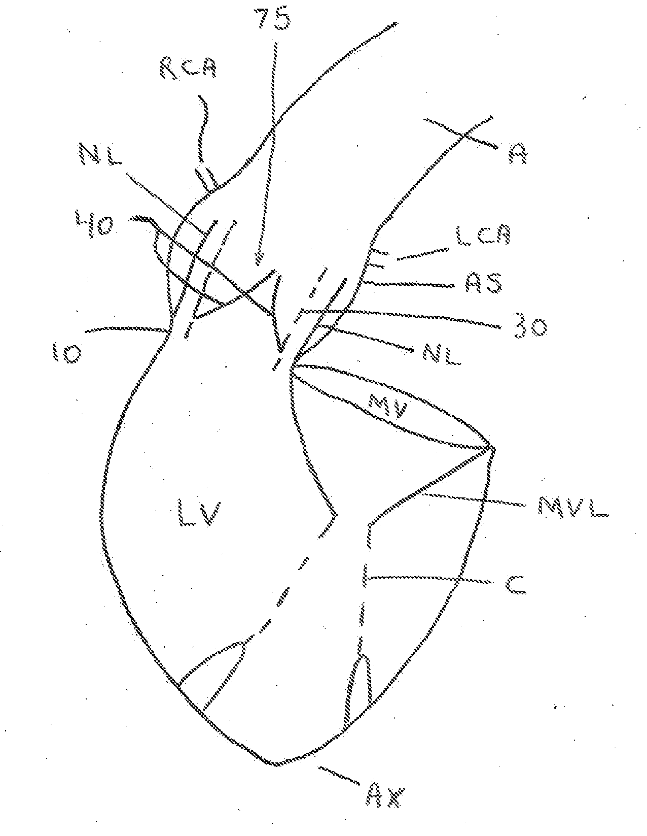 Oval Aortic Valve