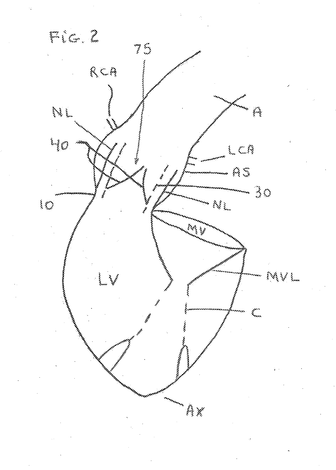 Oval Aortic Valve
