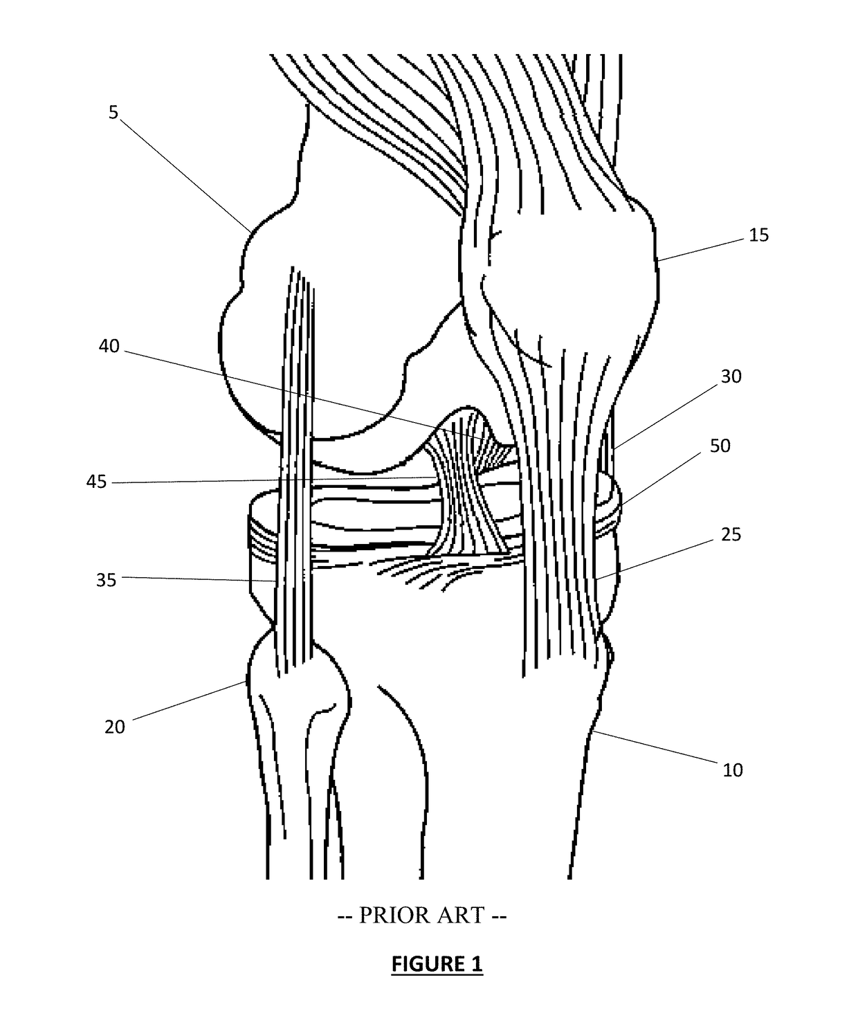 Total knee arthroplasty system and method