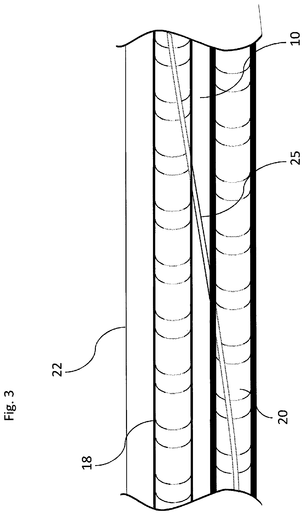 Externally supported anastomosis