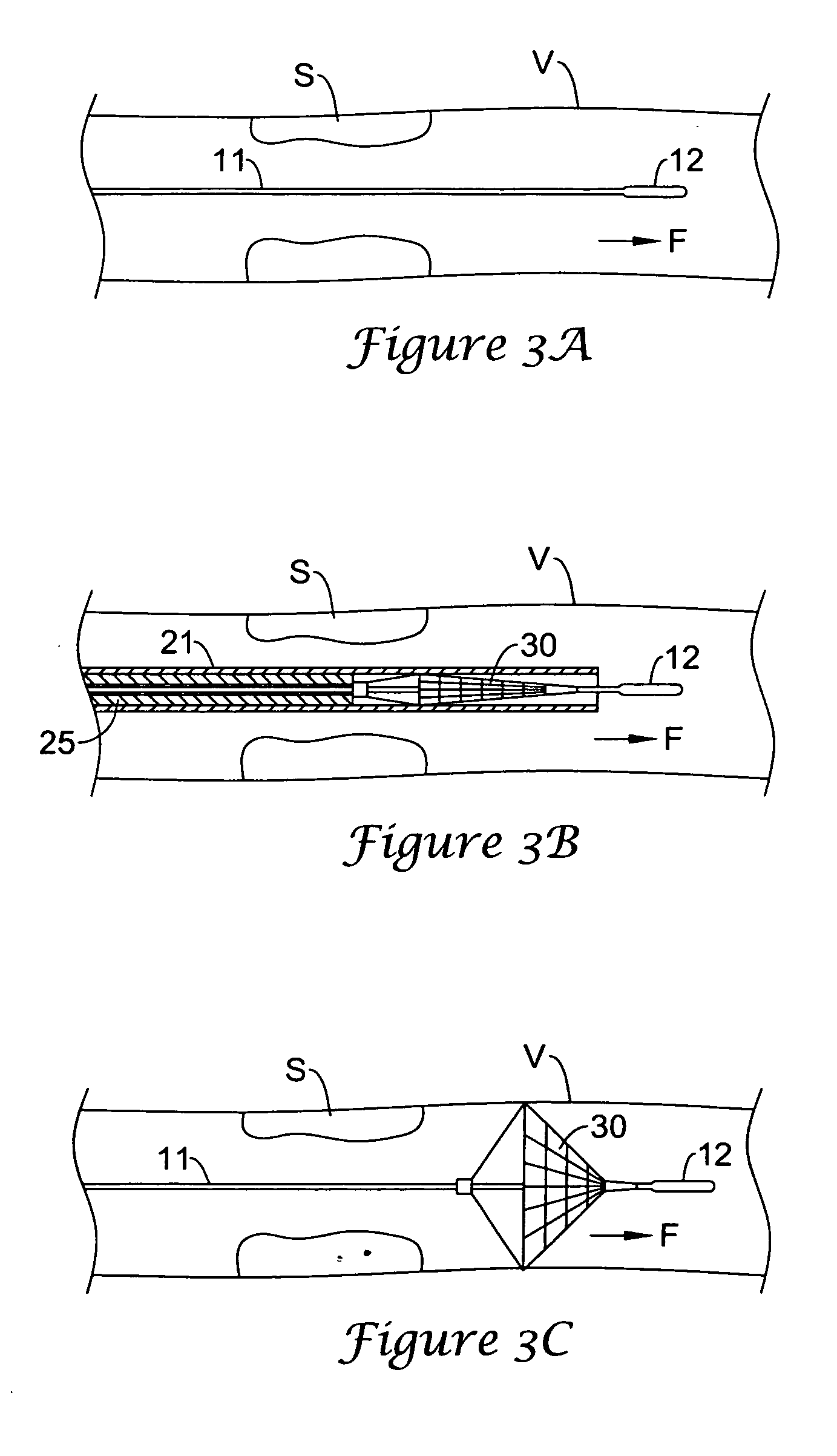 Emboli filtration system and methods of use
