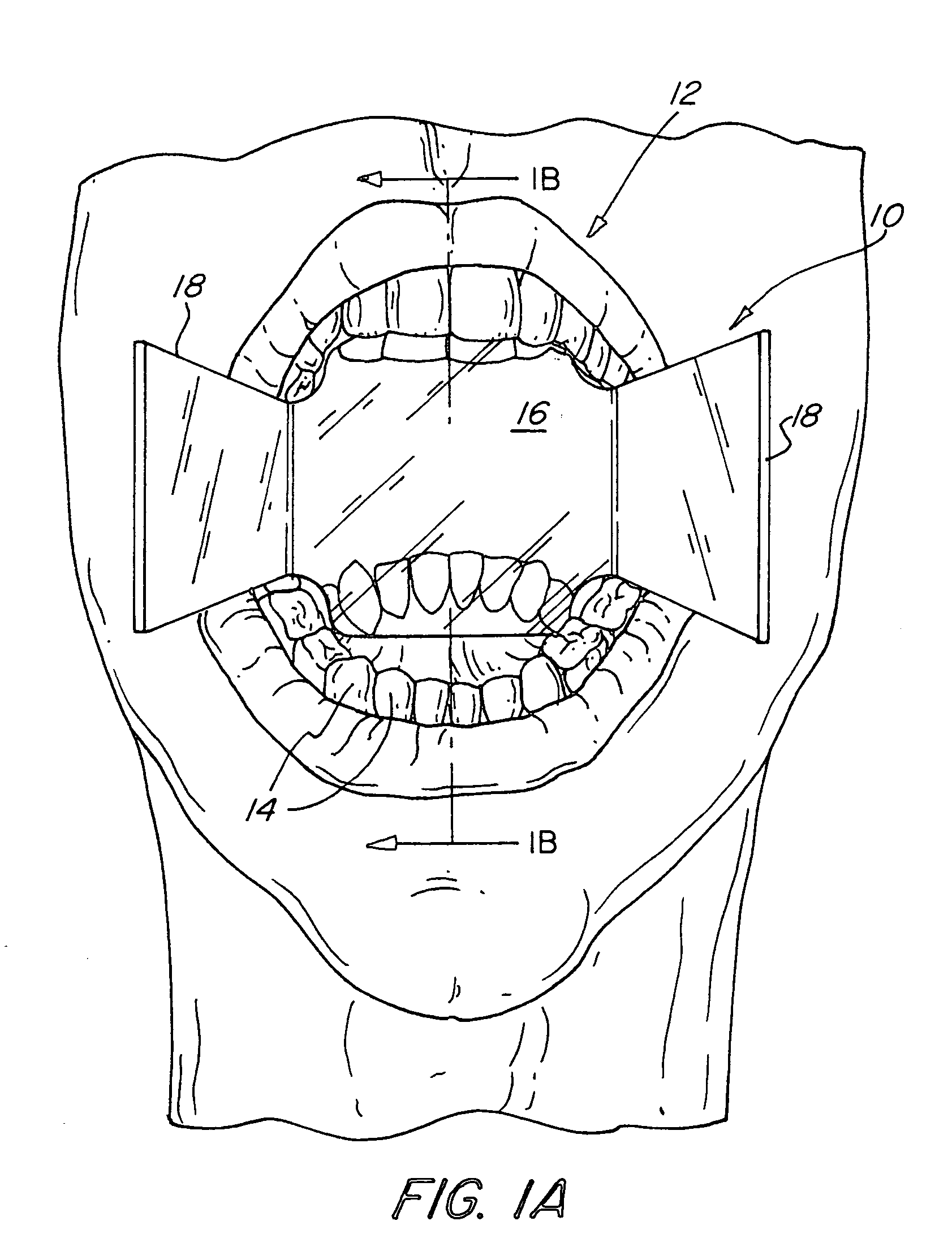 Dental unilateral bite block